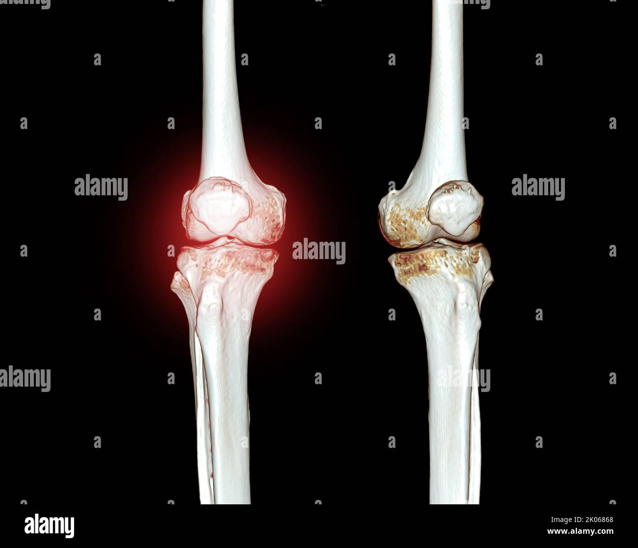 Image de rendu CT genou 3D isolée sur fond noir pour le diagnostic de fracture du genou. Banque D'Images Image de rendu CT genou 3D isolée sur fond noir pour le diagnostic de fracture du genou. Banque D'Images