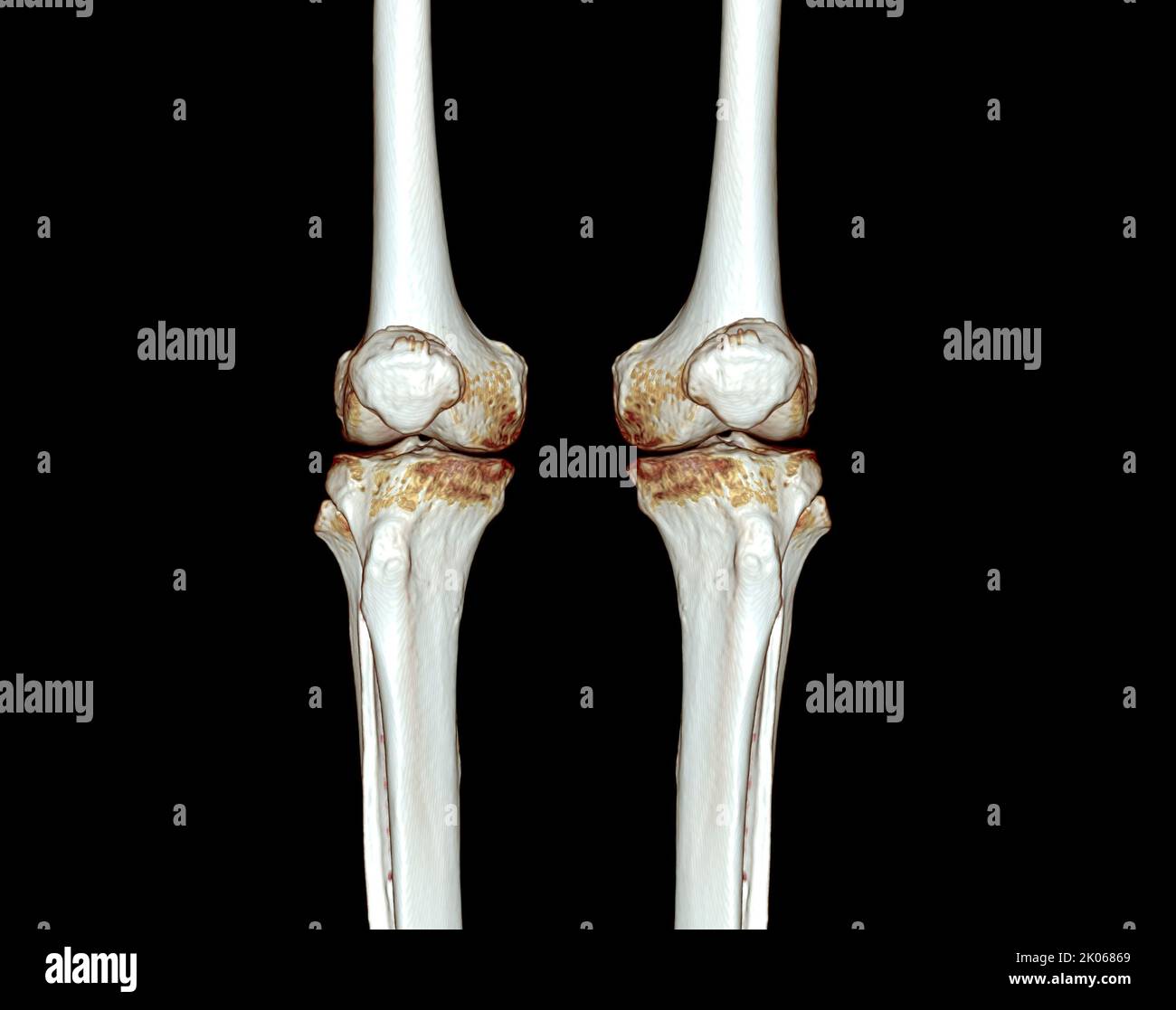 CT Scan of Knee 3D image de rendu isolée sur fond noir pour le diagnostic de la fracture du genou. Banque D'Images CT Scan of Knee 3D image de rendu isolée sur fond noir pour le diagnostic de la fracture du genou. Banque D'Images