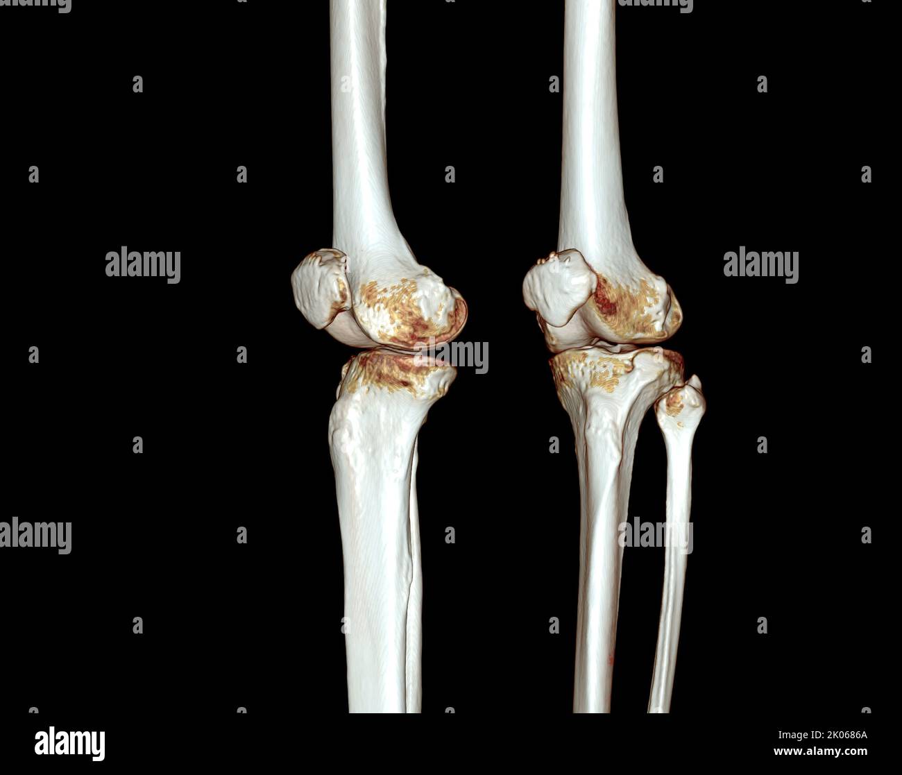 CT Scan of Knee 3D image de rendu isolée sur fond noir pour le diagnostic de la fracture du genou. Banque D'Images CT Scan of Knee 3D image de rendu isolée sur fond noir pour le diagnostic de la fracture du genou. Banque D'Images