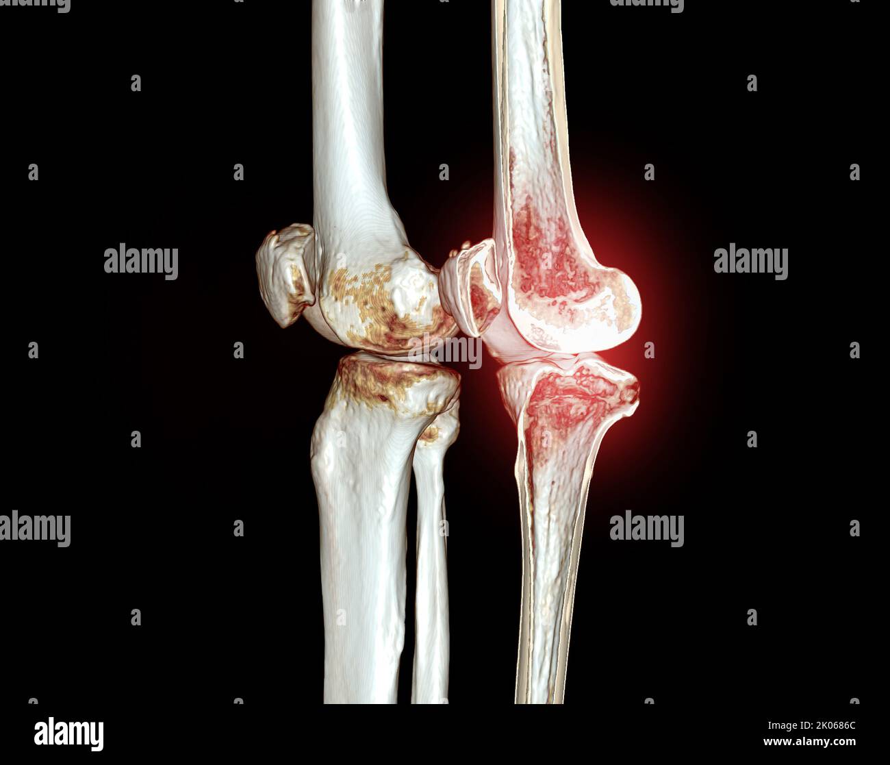 CT Scan of Knee 3D image de rendu isolée sur fond noir pour le diagnostic de la fracture du genou. Banque D'Images CT Scan of Knee 3D image de rendu isolée sur fond noir pour le diagnostic de la fracture du genou. Banque D'Images