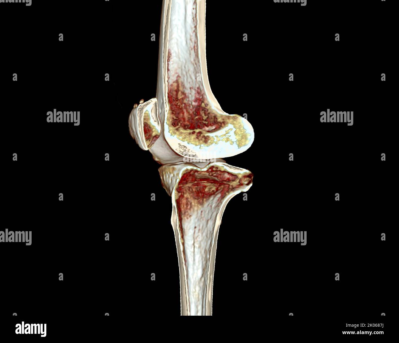 La moitié de l'acquisition CT du genou 3D rend l'image isolée sur fond noir pour le diagnostic de la fracture du genou. Banque D'Images La moitié de l'acquisition CT du genou 3D rend l'image isolée sur fond noir pour le diagnostic de la fracture du genou. Banque D'Images