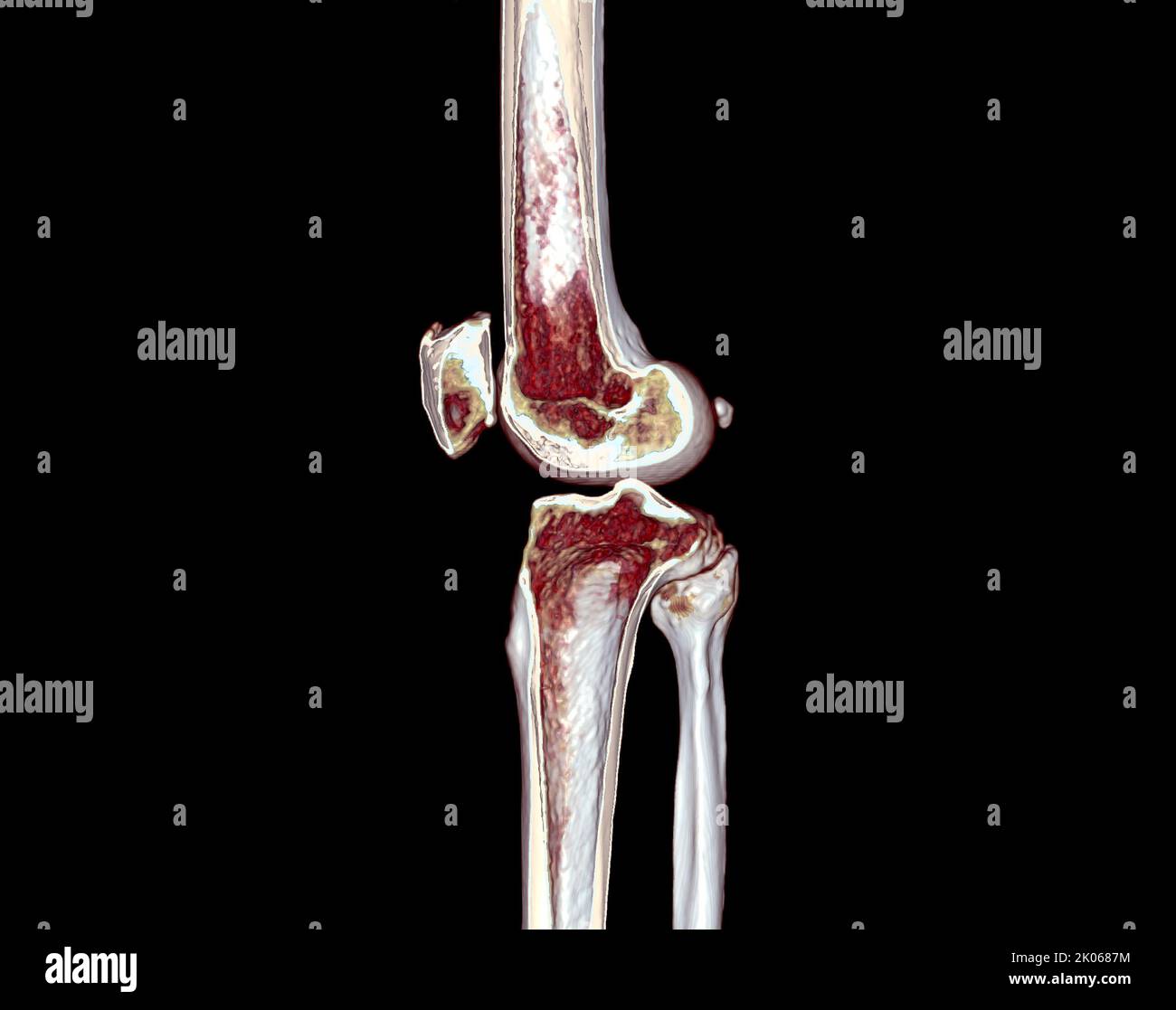 La moitié de l'acquisition CT du genou 3D rend l'image isolée sur fond noir pour le diagnostic de la fracture du genou. Banque D'Images La moitié de l'acquisition CT du genou 3D rend l'image isolée sur fond noir pour le diagnostic de la fracture du genou. Banque D'Images