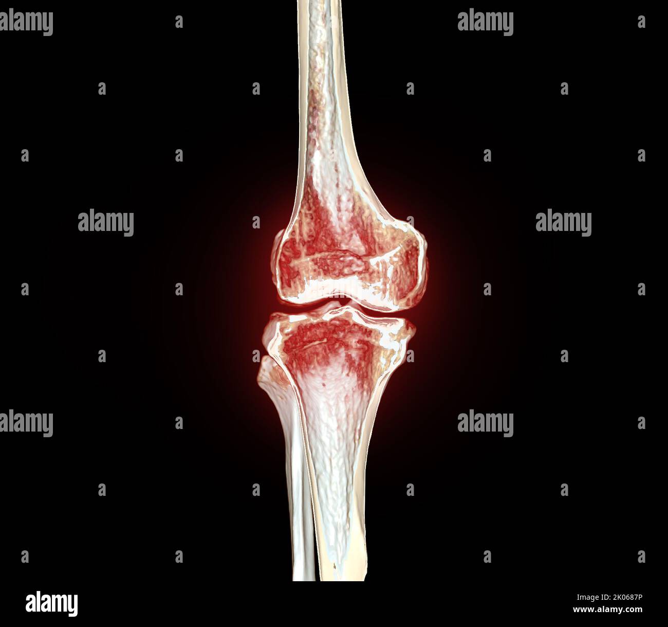La moitié de l'acquisition CT du genou 3D rend l'image isolée sur fond noir pour le diagnostic de la fracture du genou. Banque D'Images La moitié de l'acquisition CT du genou 3D rend l'image isolée sur fond noir pour le diagnostic de la fracture du genou. Banque D'Images