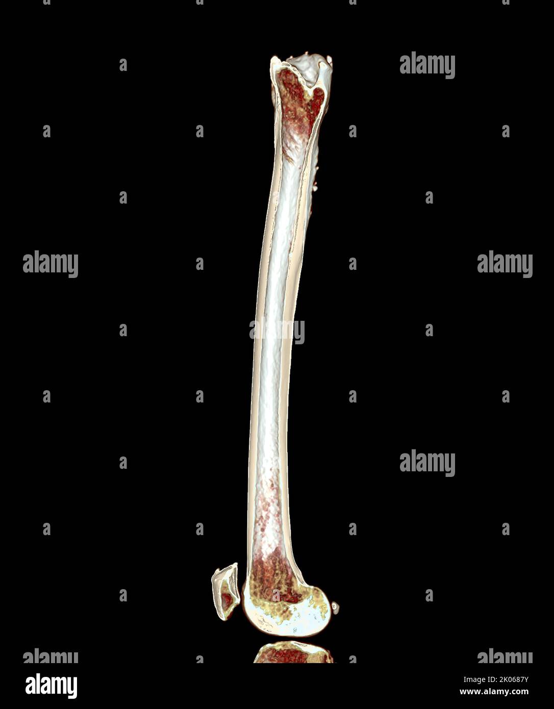 Acquisition CT du fémur de l'os de la cuisse 3D image de rendu isolée sur fond noir pour le diagnostic de la fracture du fémur. Banque D'Images Acquisition CT du fémur de l'os de la cuisse 3D image de rendu isolée sur fond noir pour le diagnostic de la fracture du fémur. Banque D'Images