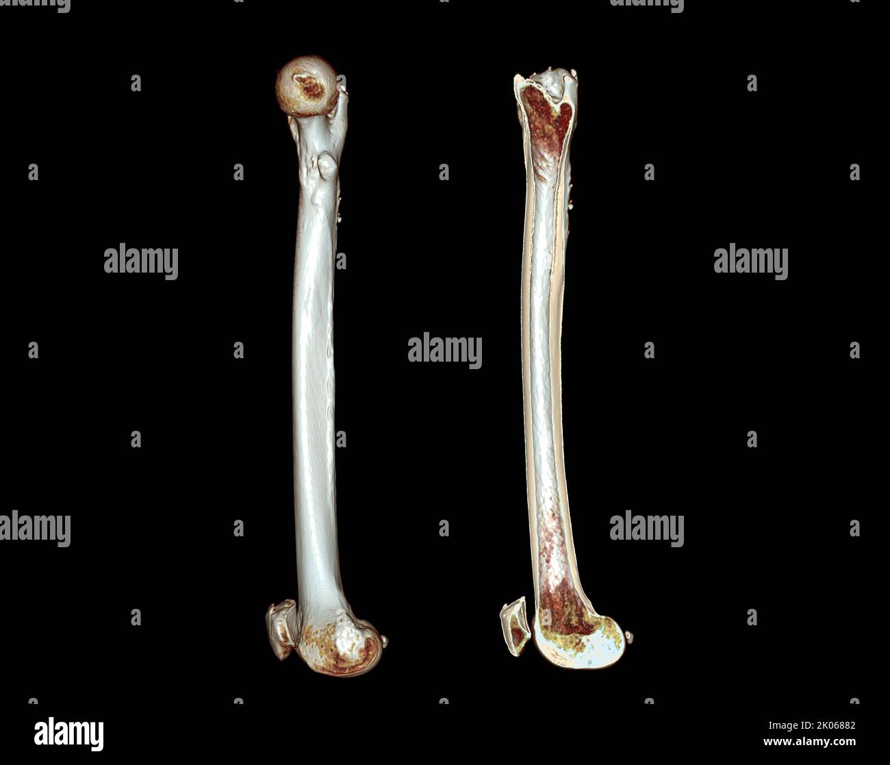 Acquisition CT du fémur de l'os de la cuisse 3D image de rendu isolée sur fond noir pour le diagnostic de la fracture du fémur. Banque D'Images Acquisition CT du fémur de l'os de la cuisse 3D image de rendu isolée sur fond noir pour le diagnostic de la fracture du fémur. Banque D'Images