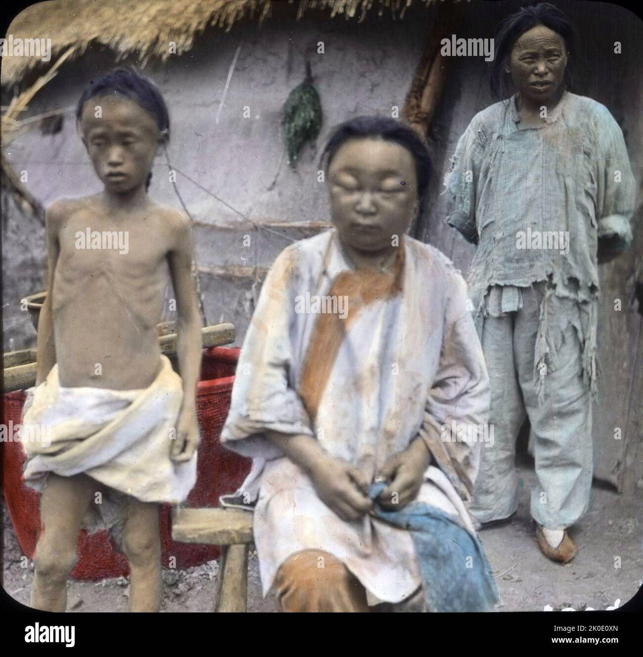 Emaciation, maladie et famine, en Corée, à la fin de l'ère Joseon 1910 Banque D'Images