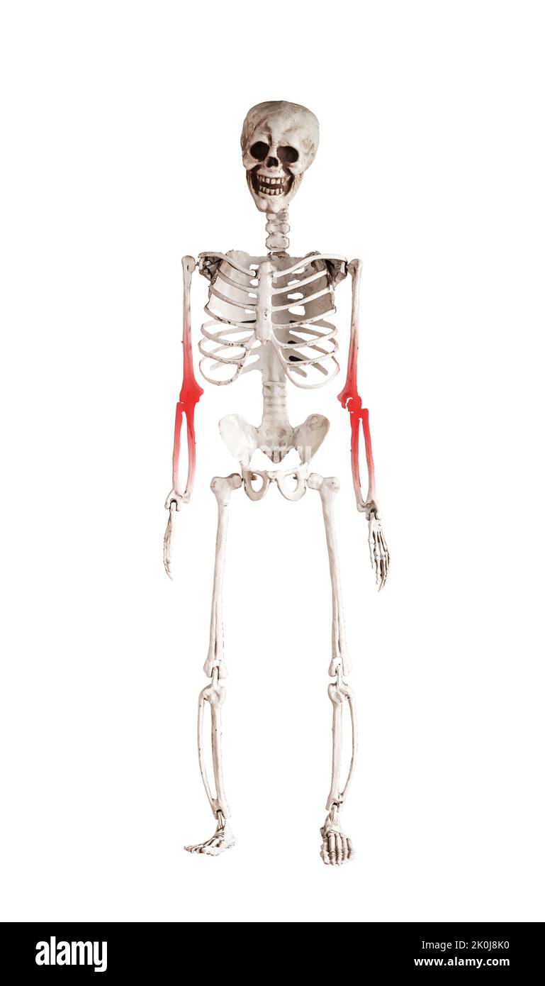 Squelette avec point rouge à l'avant-bras douloureux, coude isolé sur fond blanc. Utilisation excessive, blessures sportives, nerfs pincés, conséquences de fractures. Santé Banque D'Images