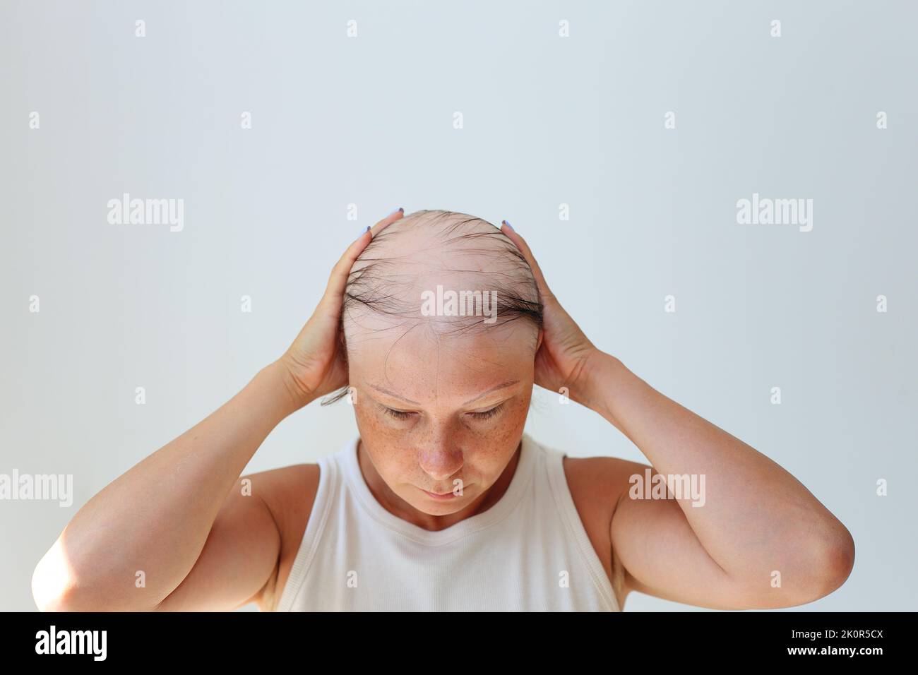 Perte de cheveux sous forme d'alopécie areata. Tête chauve d'une femme. Éclaircissement des cheveux après Covid. Patchs chauves d'alopécie totale Banque D'Images