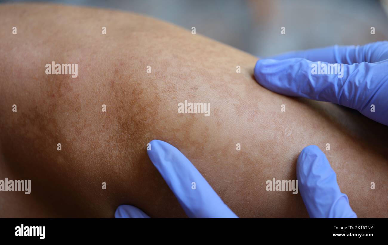 Médecin mains dans des gants de protection en caoutchouc vérifier la peau du jeune homme avec le vitiligo ou des éruptions cutanées Banque D'Images