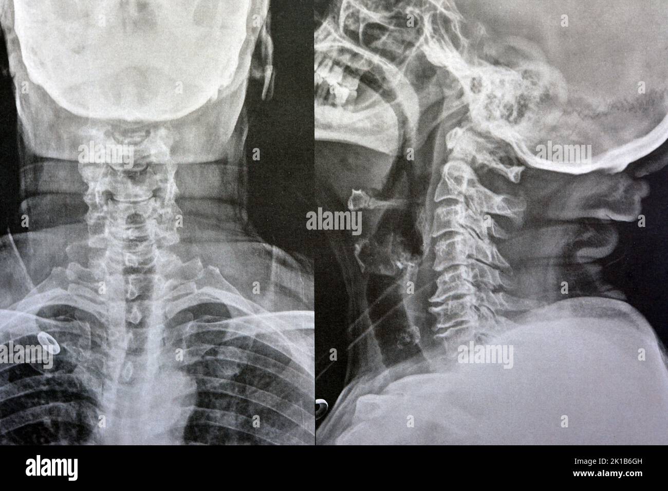 Vertèbres cervicales à rayons X simples montrant le redressement des vertèbres cervicales indiquant un spasme musculaire et une spondylosis légère à modérée à partir de C3 3rd cervicales Banque D'Images