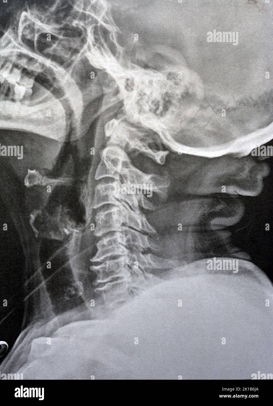 Vertèbres cervicales à rayons X simples montrant le redressement des vertèbres cervicales indiquant un spasme musculaire et une spondylosis légère à modérée à partir de C3 3rd cervicales Banque D'Images