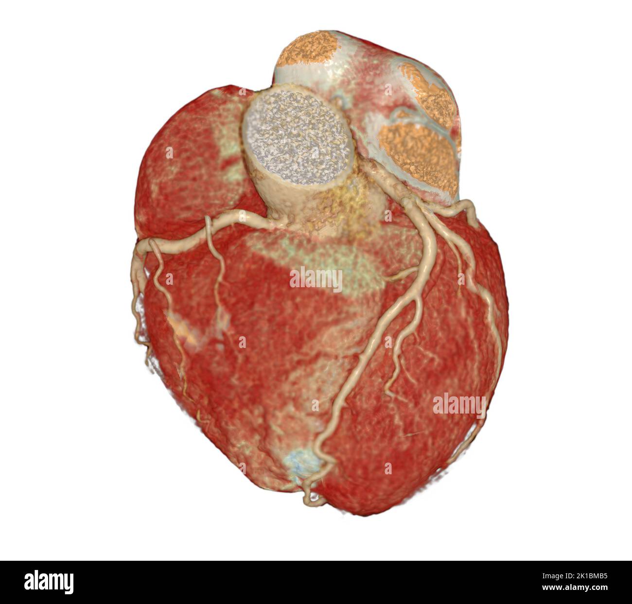 TDM cardiaque 3D ou CTA artère coronaire pour la prévention des maladies coronariennes.Clipping path. Banque D'Images