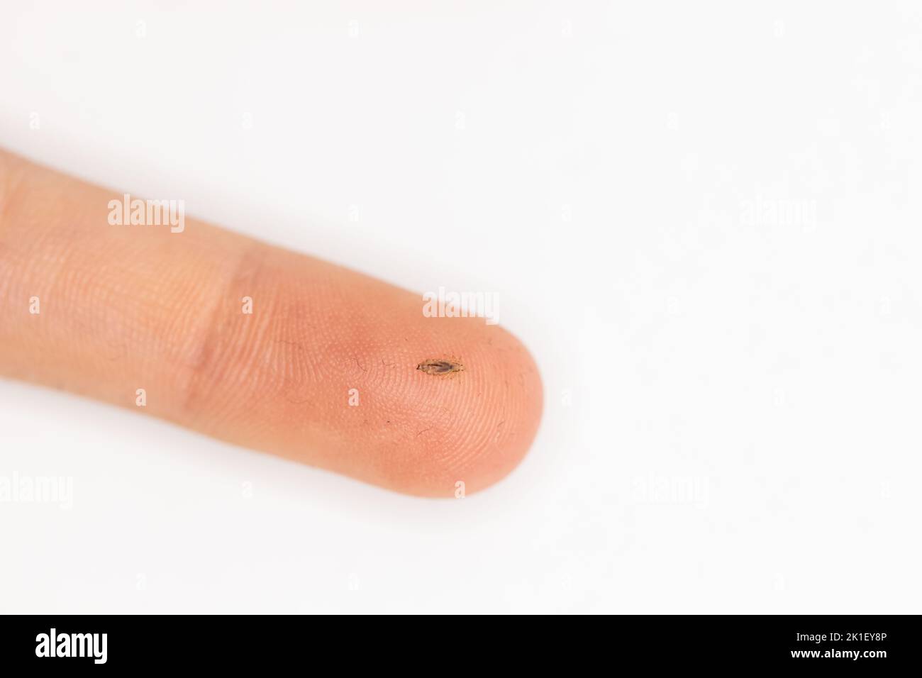 Une souris humaine sur un doigt lorsque des poux ont été découverts dans les cheveux d'un enfant Banque D'Images