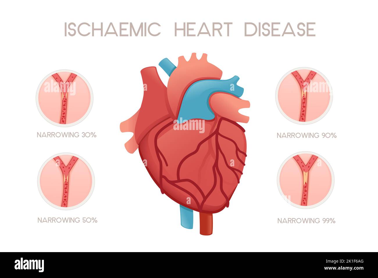 Coeur humain malsain avec la maladie ischémique illustration de l'anatomie problème de santé illustration du vecteur sur fond blanc Illustration de Vecteur
