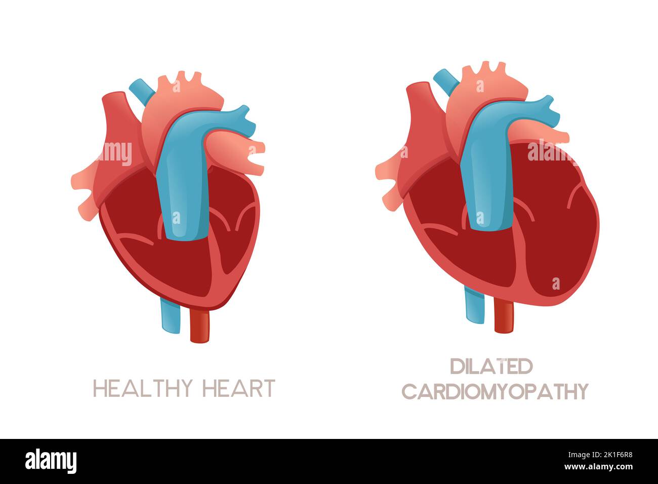 Coeur et coeur humains sains avec cardiomyopathie dilatée illustration anatomie problème de santé illustration vecteur sur fond blanc Illustration de Vecteur