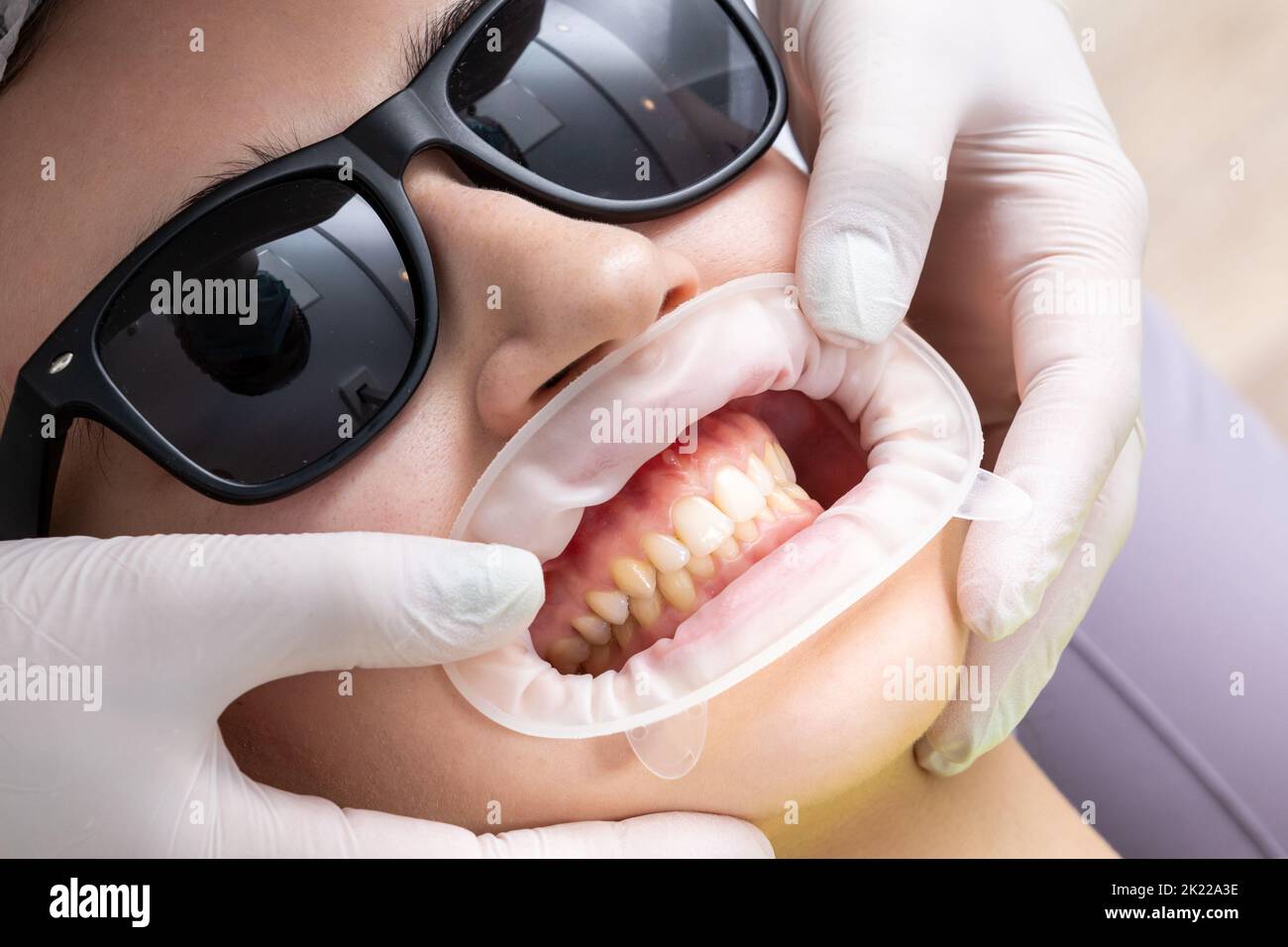 Patient avec enrouleur de joue allongé dans le cabinet du dentiste Banque D'Images Patient avec enrouleur de joue allongé dans le cabinet du dentiste Banque D'Images