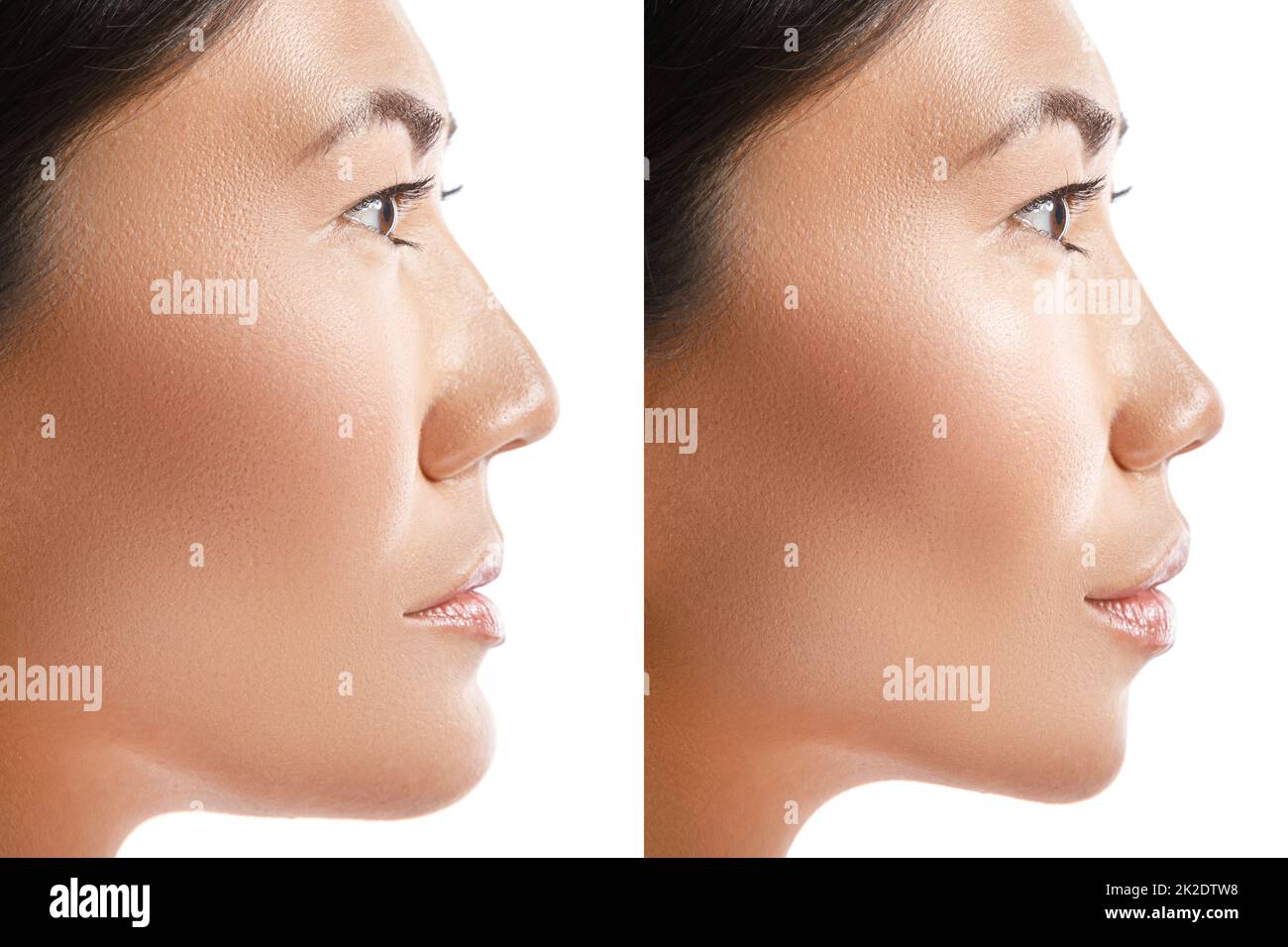 Transformation de la femme asiatique. Résultat de la chirurgie plastique. Banque D'Images