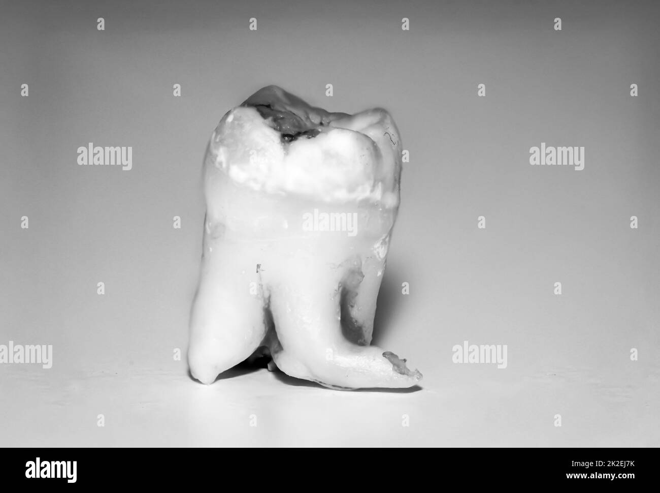 Un gros plan d'une dent de sagesse extraite avec une racine grombling. Banque D'Images