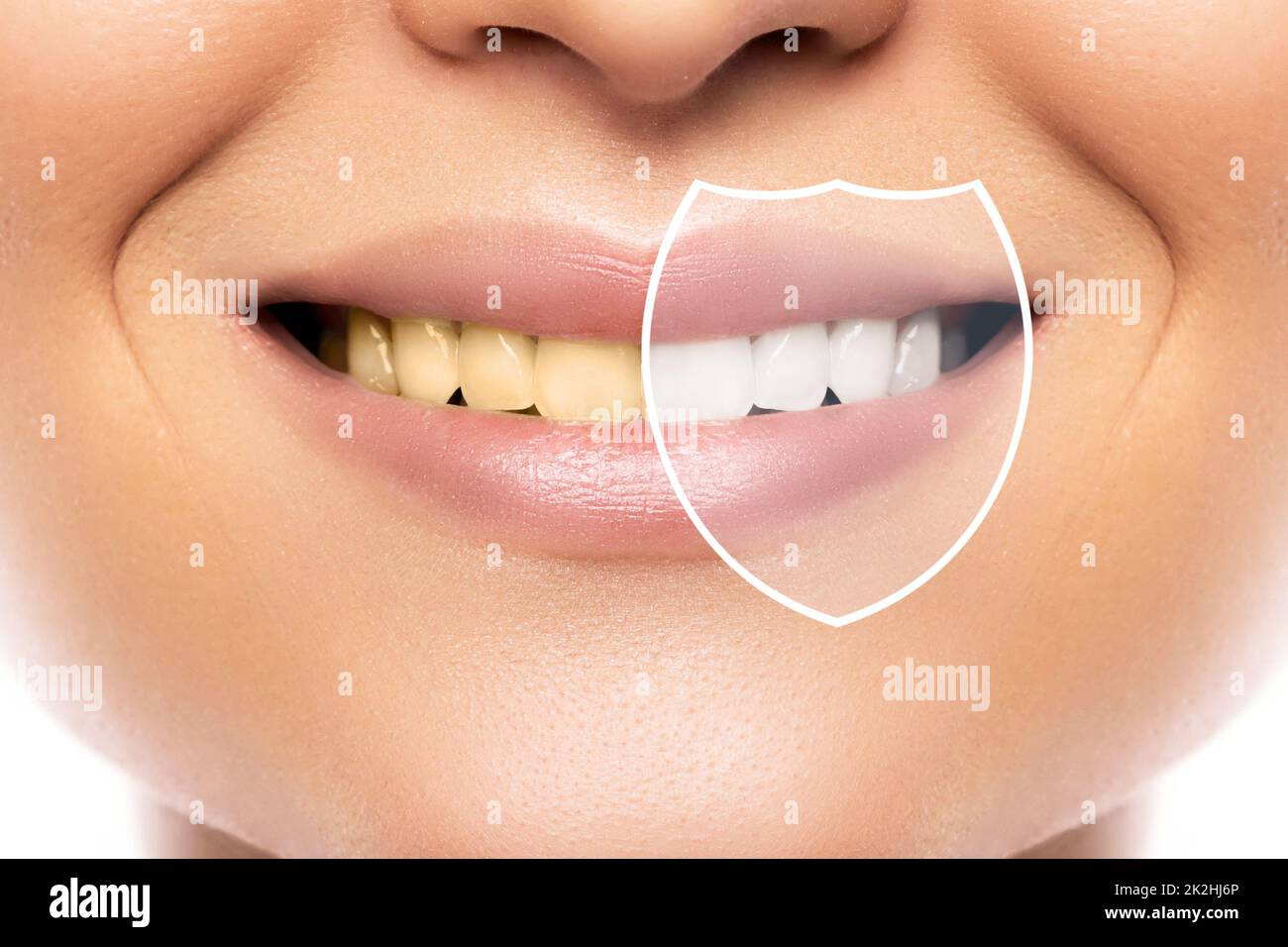 Blanchiment et hygiène des dents. Résultat après traitement dans une clinique dentaire professionnelle. Banque D'Images