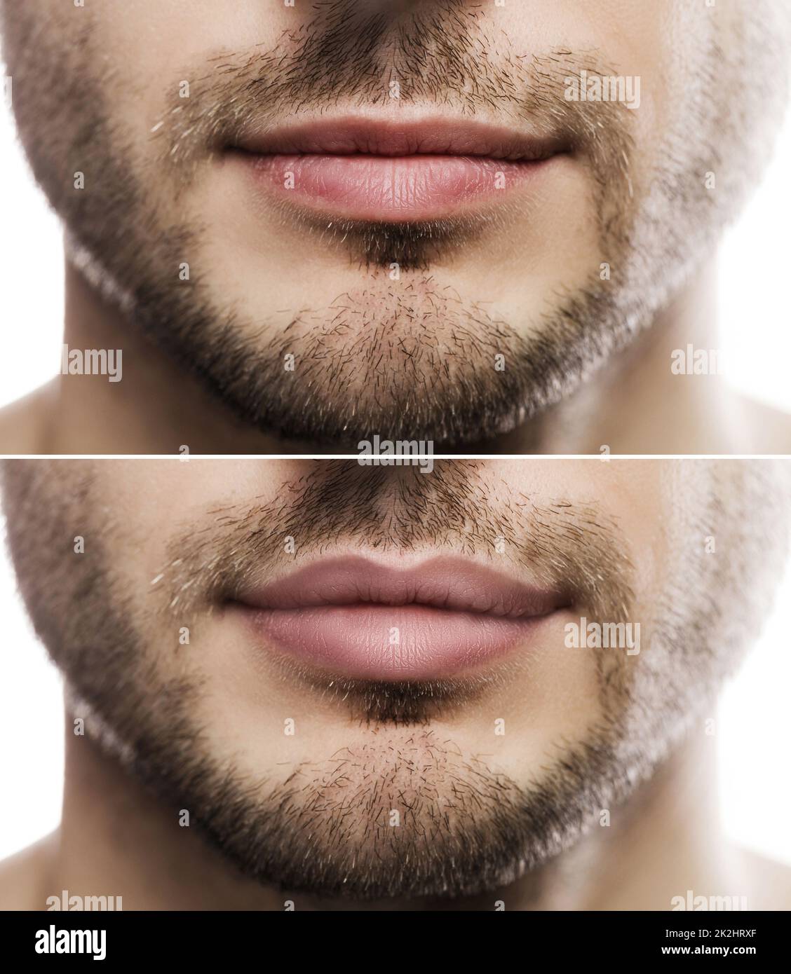Augmentation des lèvres. Lèvres mâles avant et après l'injection de remplissage. Banque D'Images