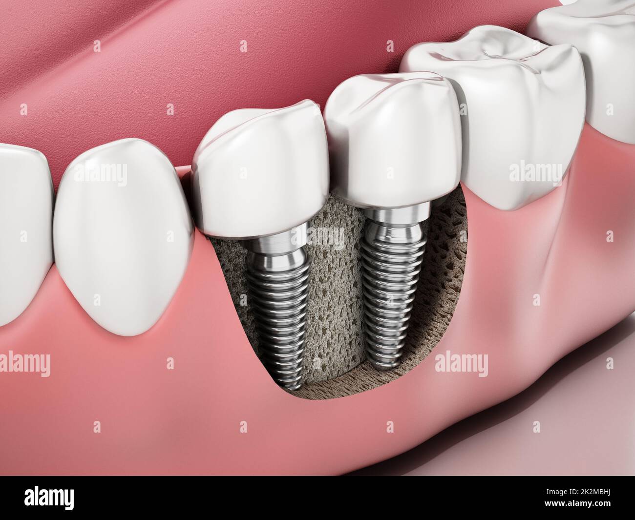 3D illustration de deux implants dentaires sur la mâchoire inférieure Banque D'Images