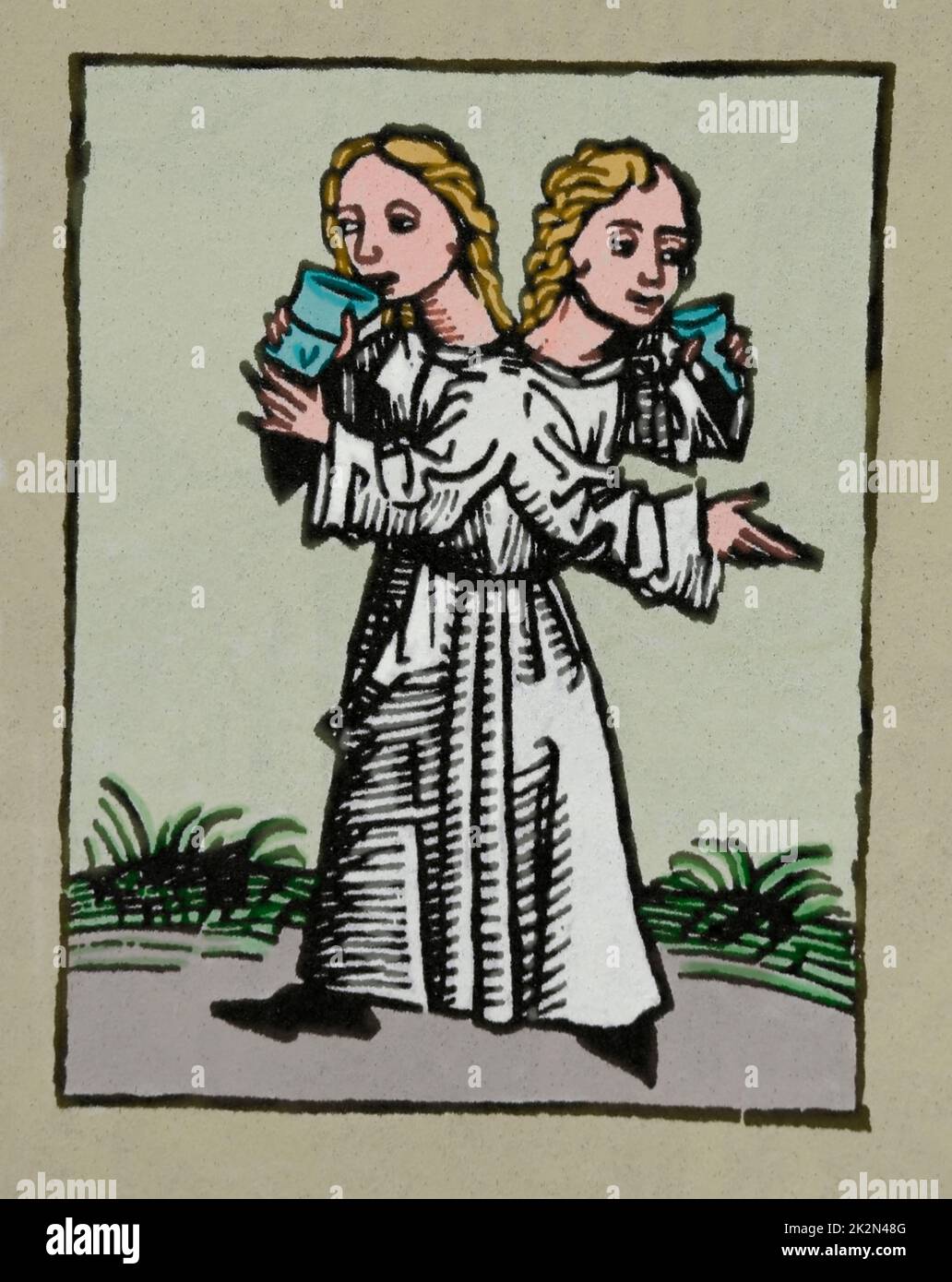 Jumeaux joints ou siameses jumeaux. Gravure. Le Cronicle de Nuremberg, 15th siècle. Banque D'Images