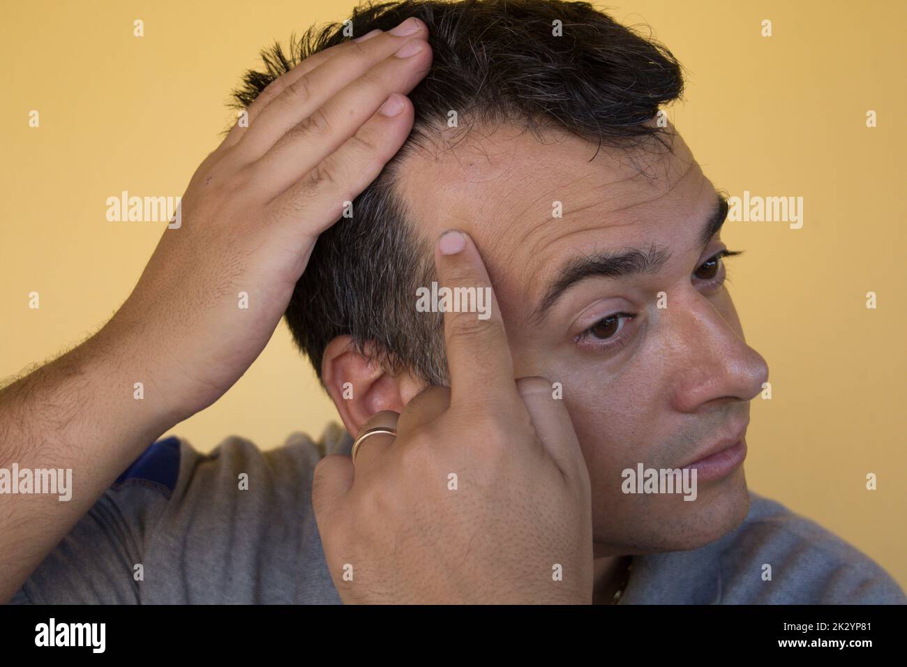 Image d'un homme montrant le début de la perte de cheveux et le principe de la diminution des cheveux. Causes possibles et remèdes pour la perte de cheveux Banque D'Images