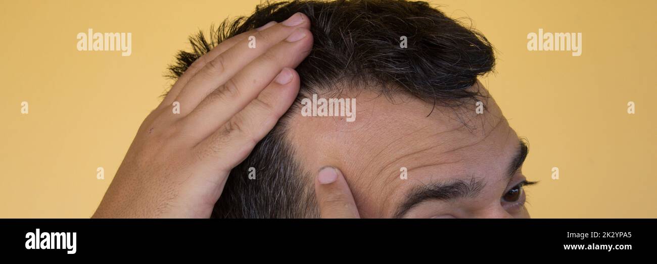 Image d'un homme montrant le début de la perte de cheveux et le principe de la diminution des cheveux. Causes possibles et remèdes pour la perte de cheveux. Bannière horizontale Banque D'Images
