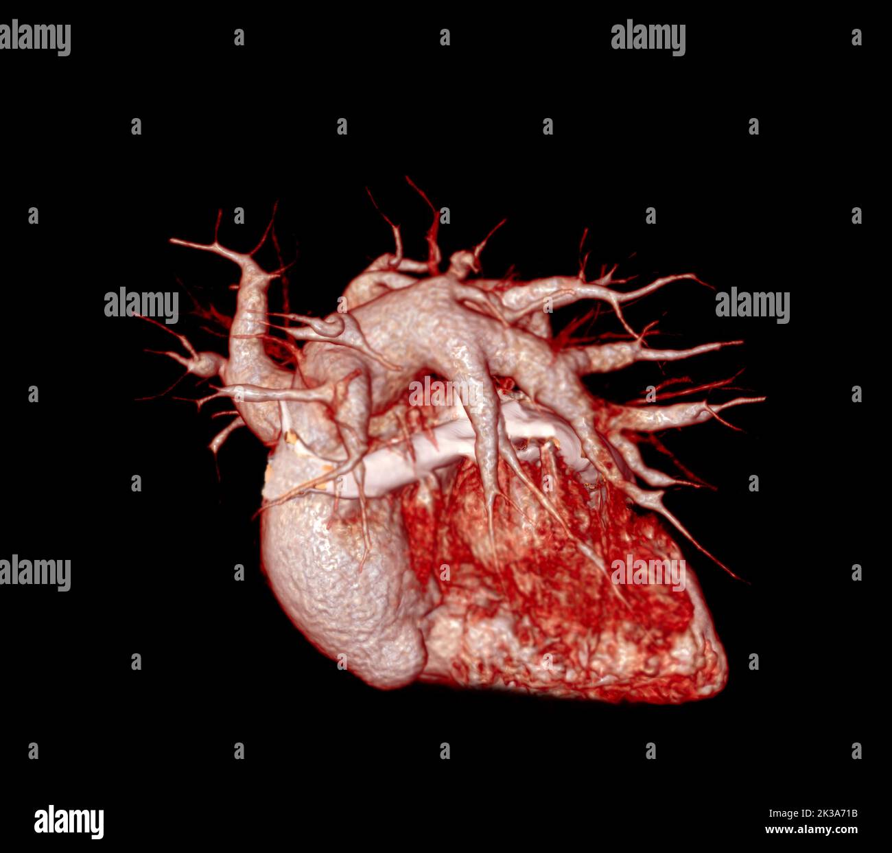 CTA artères pulmonaires 3D rendu montrant la branche de l'artère pulmonaire Banque D'Images