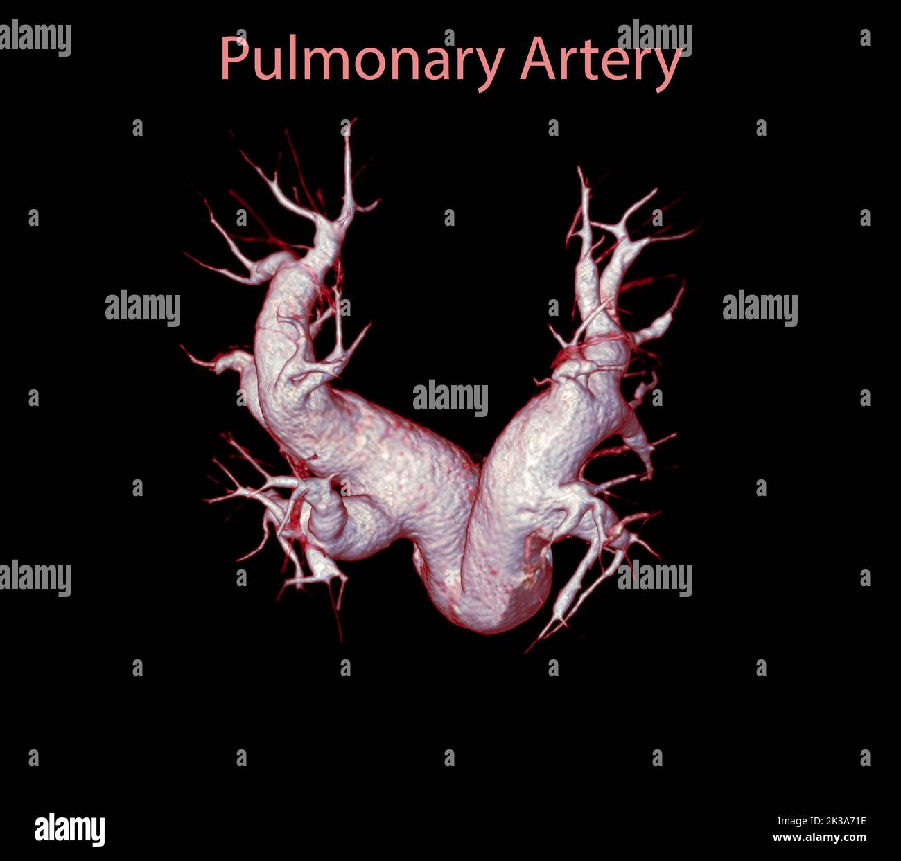 CTA artères pulmonaires 3D rendu montrant la branche de l'artère pulmonaire Banque D'Images