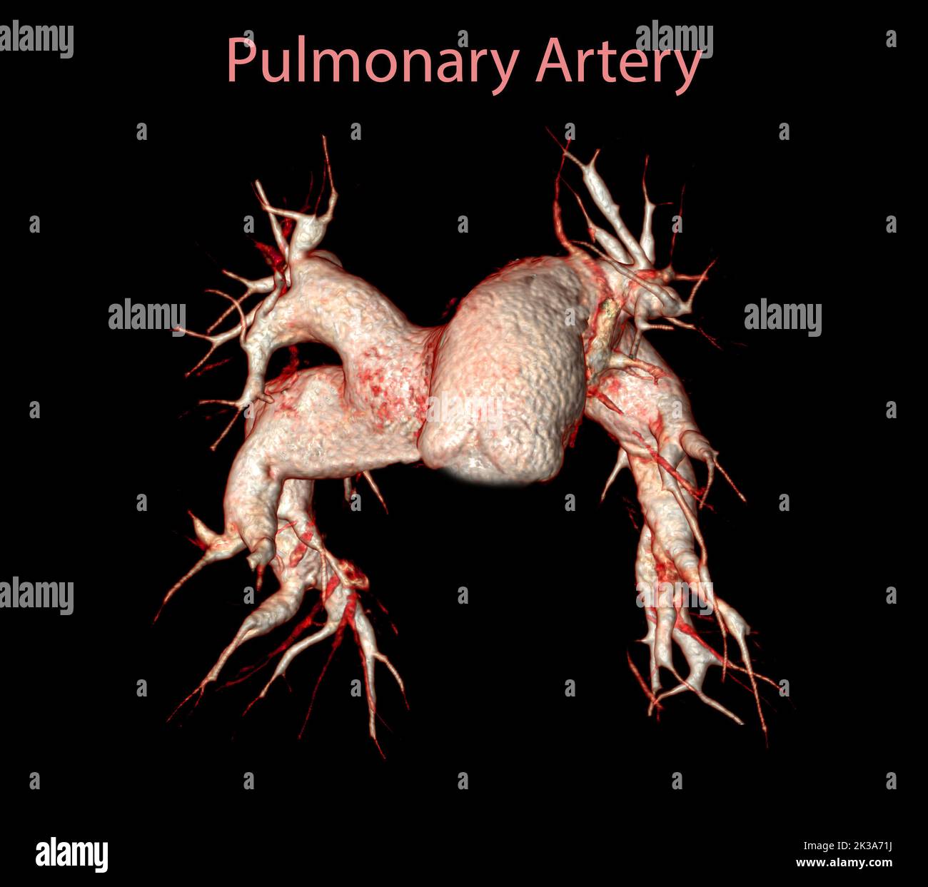 CTA artères pulmonaires 3D rendu montrant la branche de l'artère pulmonaire Banque D'Images