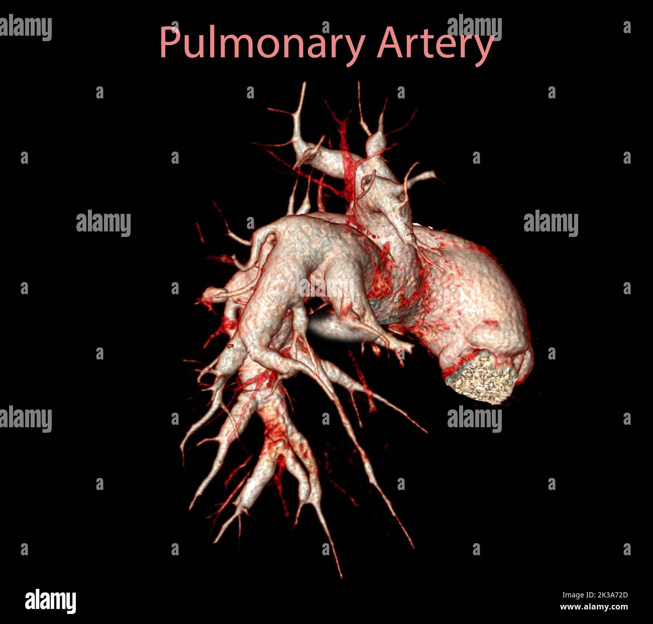 CTA artères pulmonaires 3D rendu montrant la branche de l'artère pulmonaire Banque D'Images