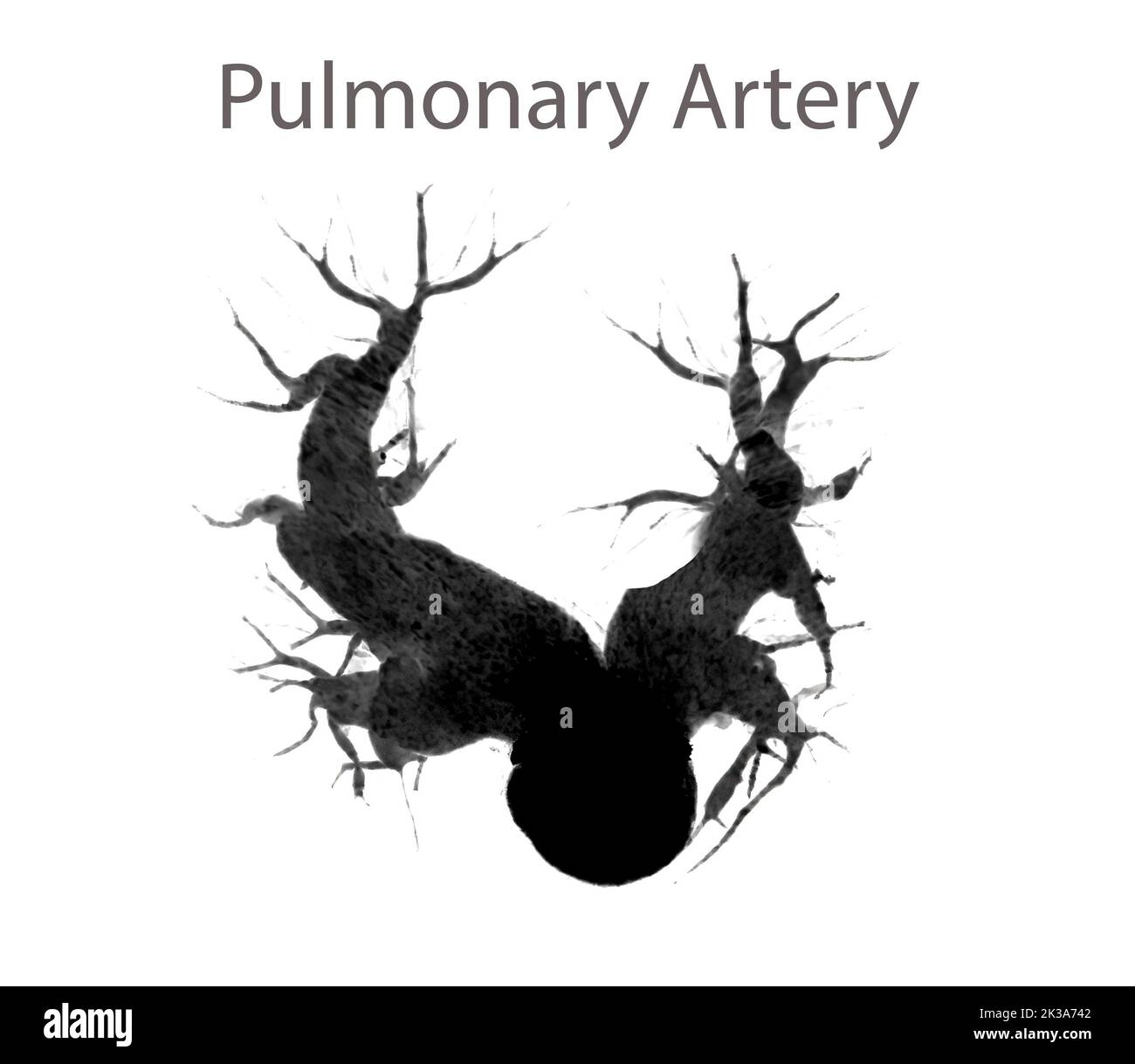 Artères pulmonaires CTA montrant la branche de l'artère pulmonaire Banque D'Images