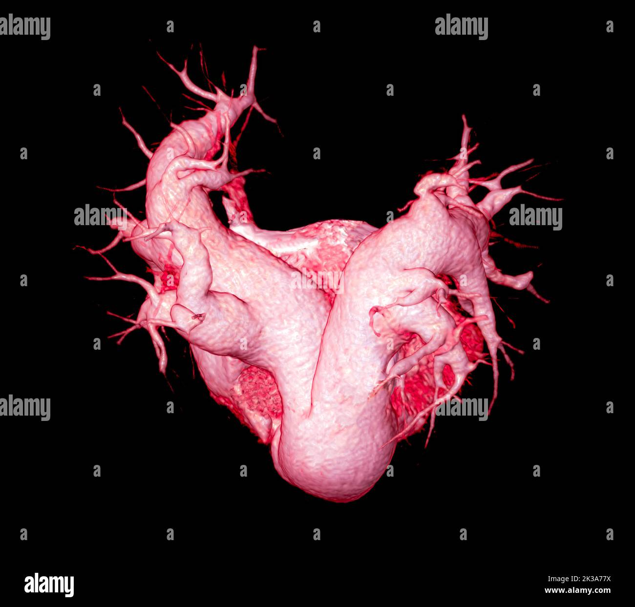 CTA artères pulmonaires 3D rendu montrant la branche de l'artère pulmonaire Banque D'Images