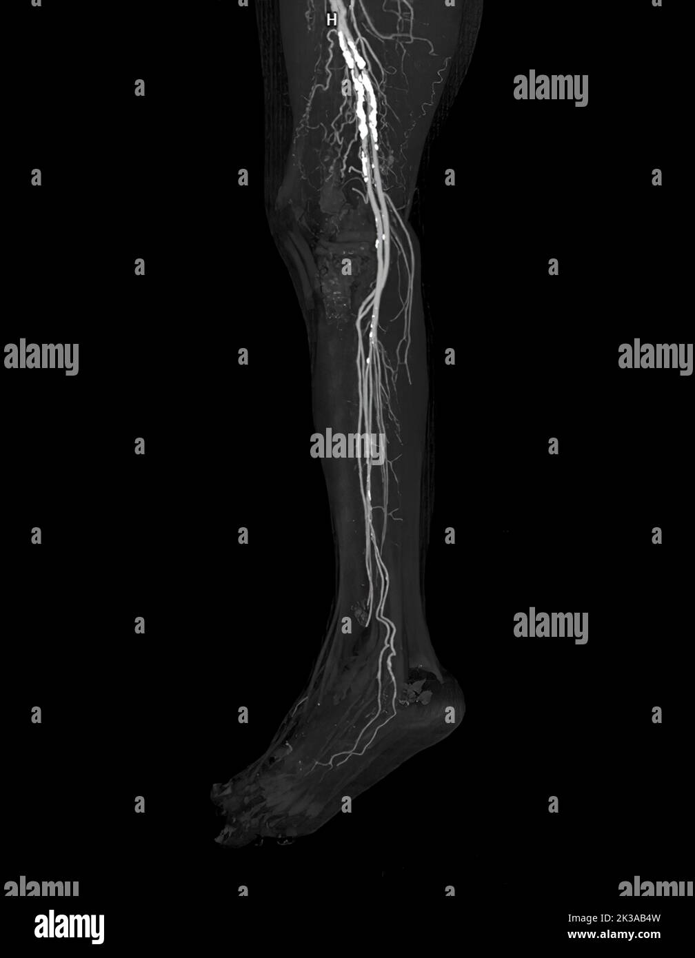 L'artère fémorale CTA est une image de l'artère fémorale présentant une maladie artérielle périphérique aiguë ou chronique. Banque D'Images