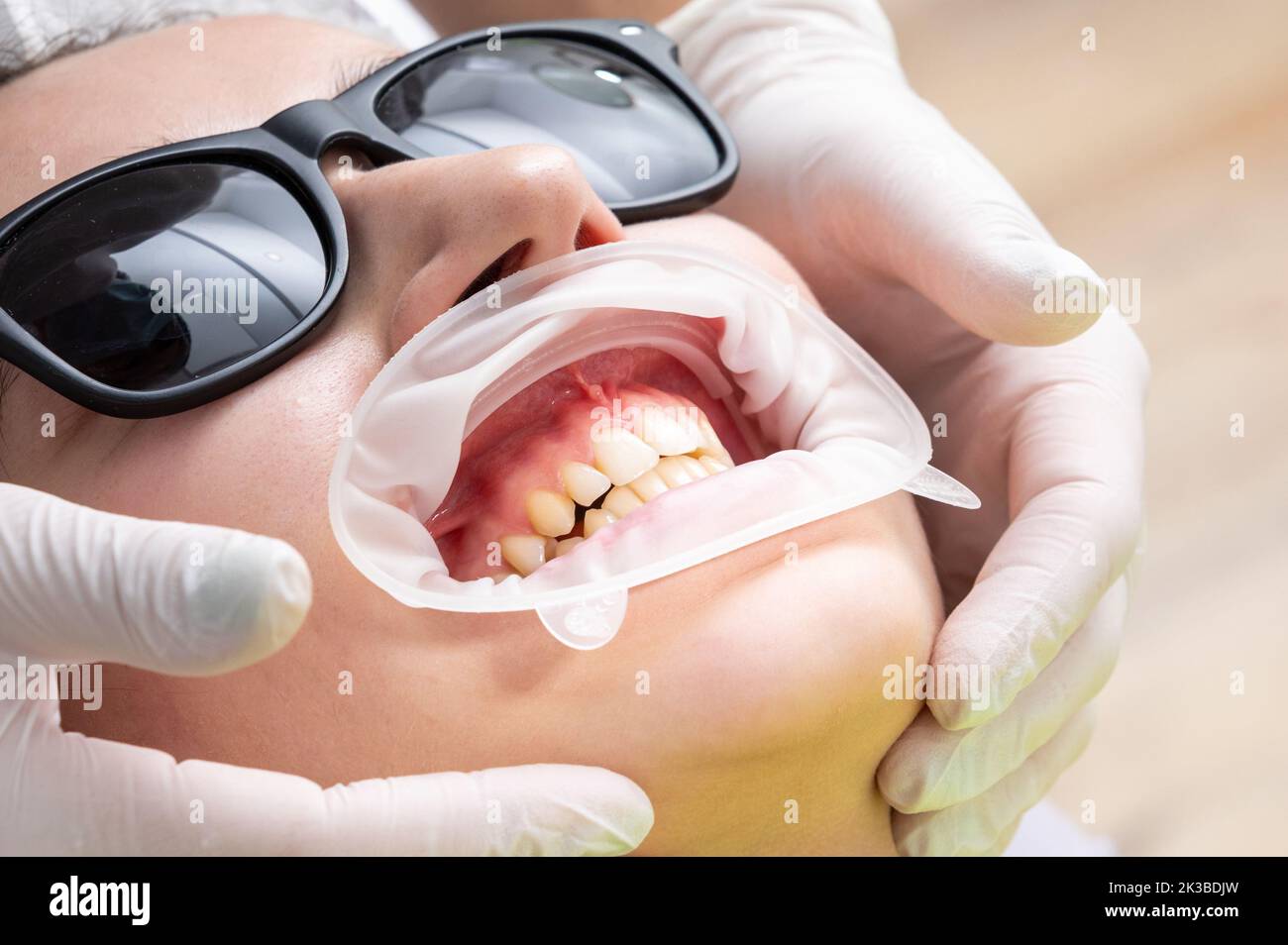 Patient avec enrouleur de joue allongé dans le cabinet du dentiste Banque D'Images Patient avec enrouleur de joue allongé dans le cabinet du dentiste Banque D'Images