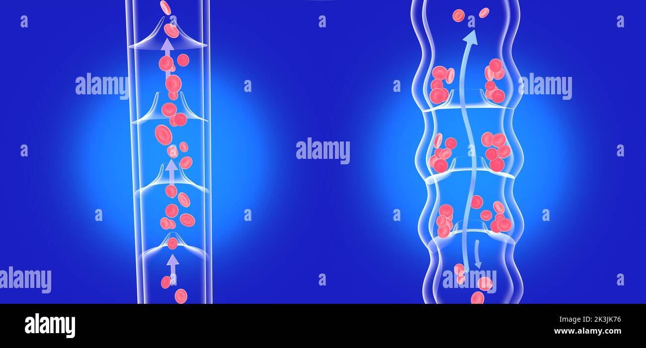 Illustration anatomique 3D de deux images, une veine incompétente