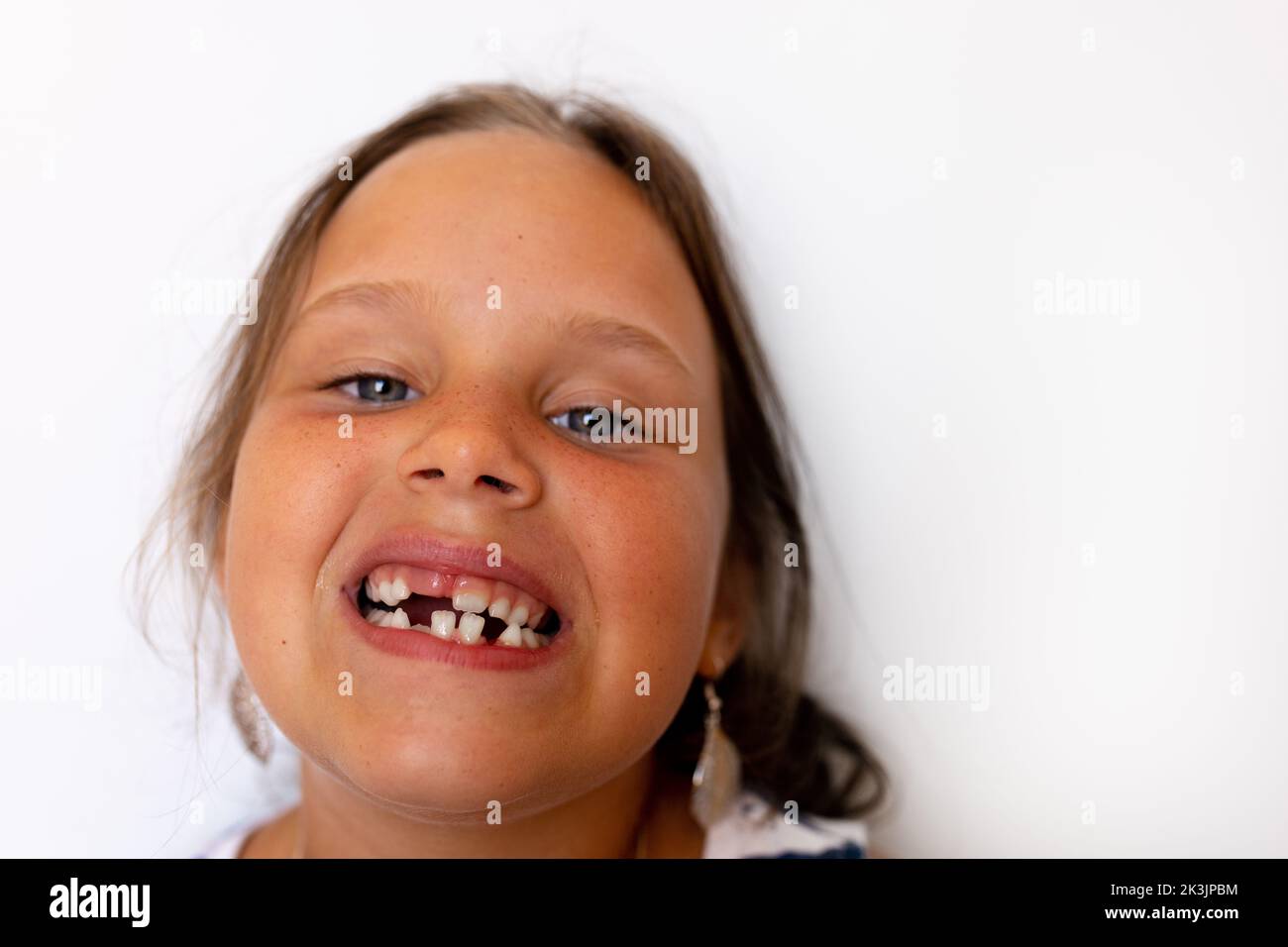 Adorable fille à bouche ouverte sans dents avec dents temporaires de lait entassant les dents dans le studio blanc. Travail dentaire avec morsure croisée Banque D'Images
