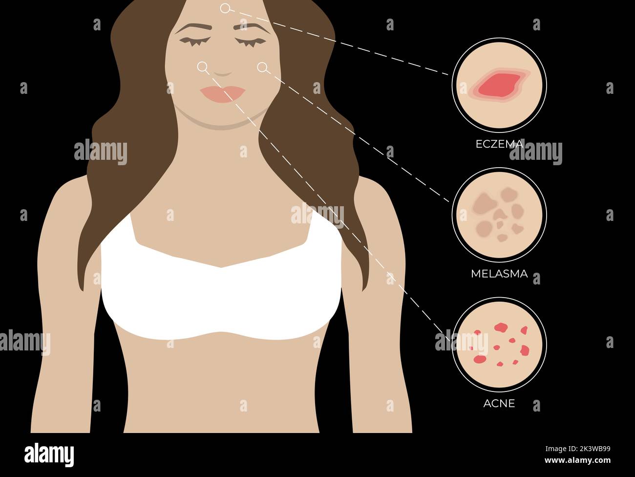 Illustration de l'eczéma, de l'acné et du mélasma avec la femme sur fond noir Illustration de Vecteur