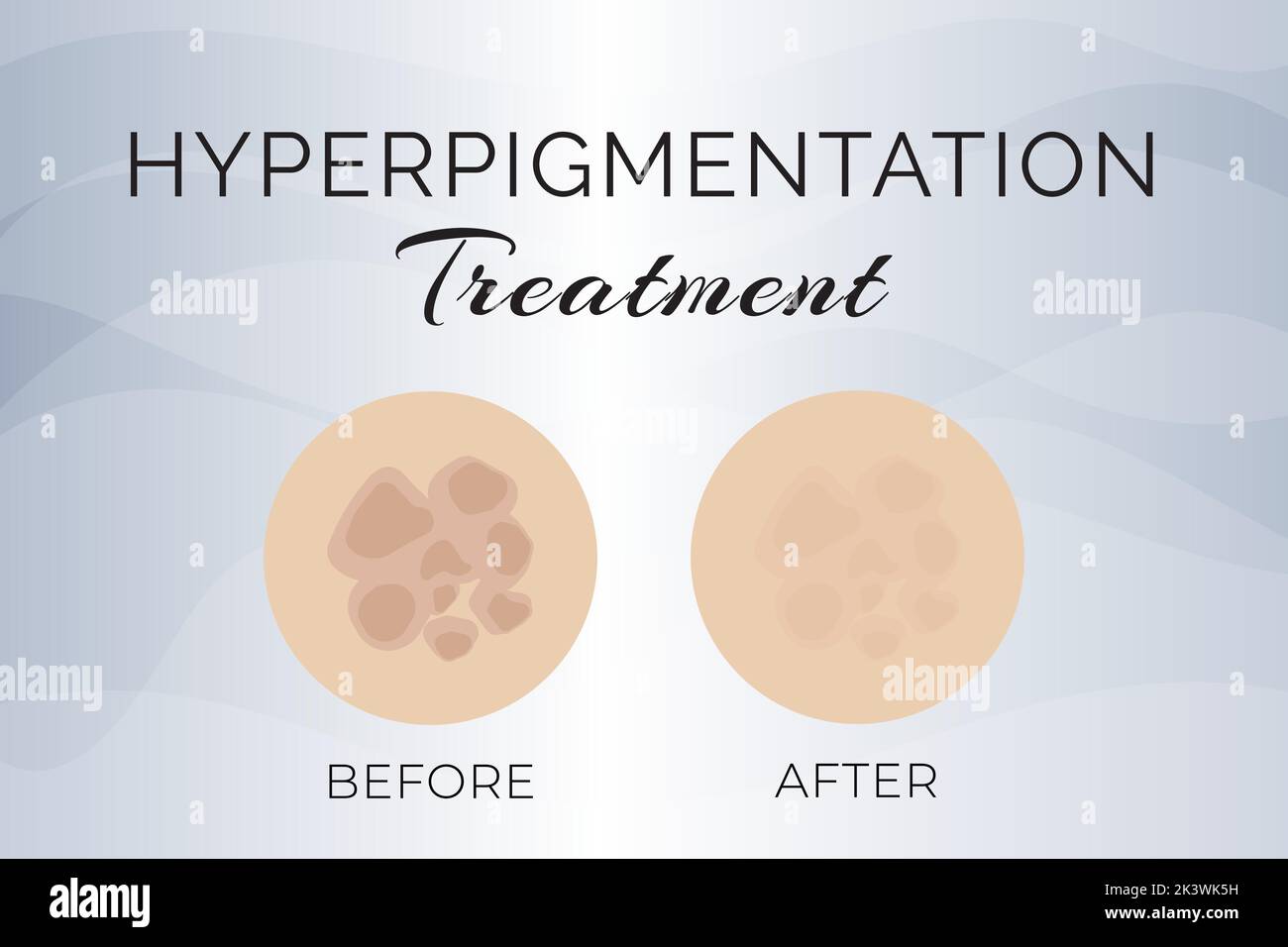 Traitement de l'hyperpigmentation avant et après Illustration Design Illustration de Vecteur Traitement de l'hyperpigmentation avant et après Illustration Design Illustration de Vecteur