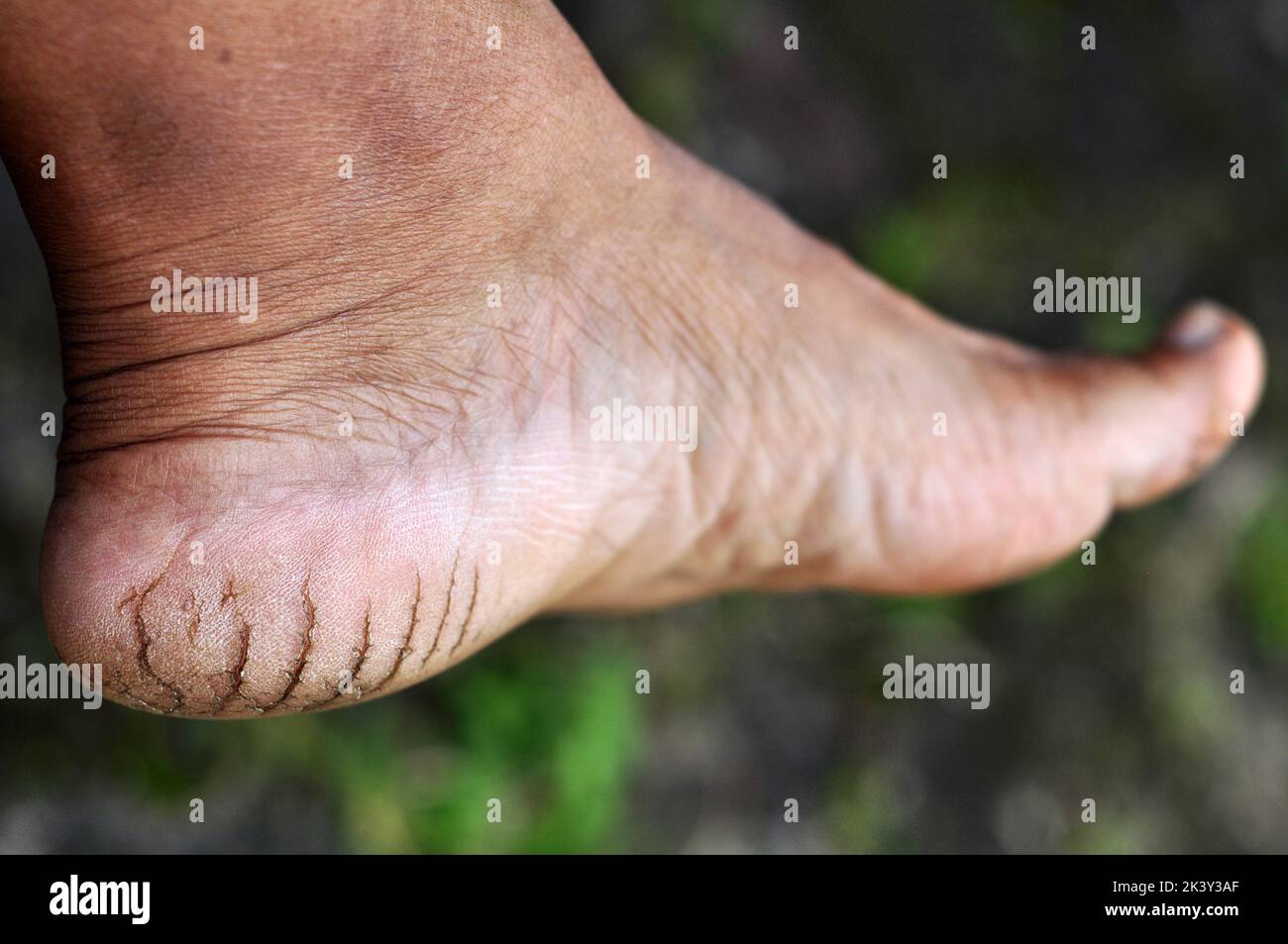Talons secs et fissurés en raison du manque d'humidité dans les pieds Banque D'Images