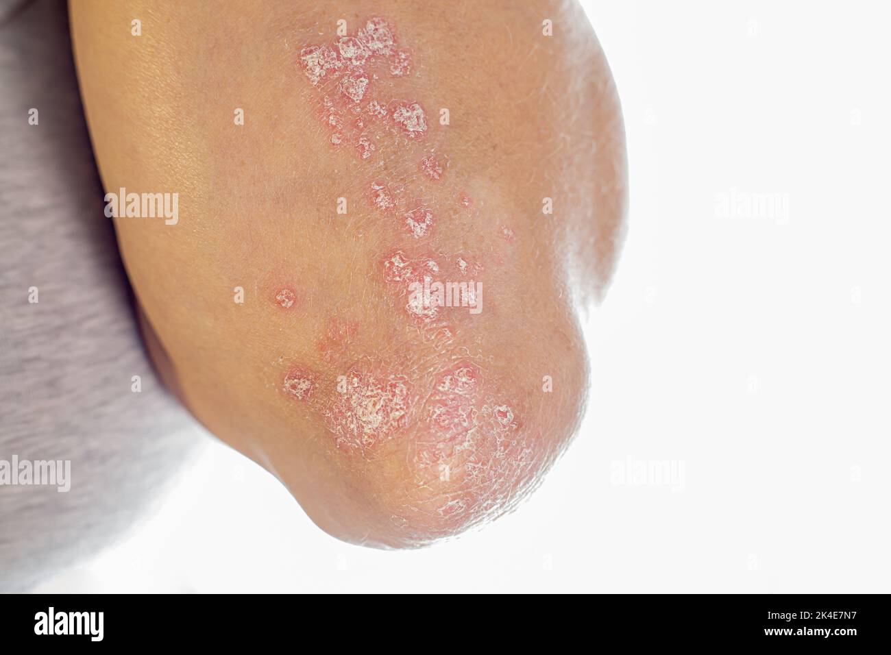 Psoriasis sur les coudes .Fermer le psoriasis incurable de maladies dermatologiques auto-immunes de la peau. Éruption cutanée enflammée et feuilletée sur les coudes. Articulations affectées par le rhumatisme psoriasique Banque D'Images