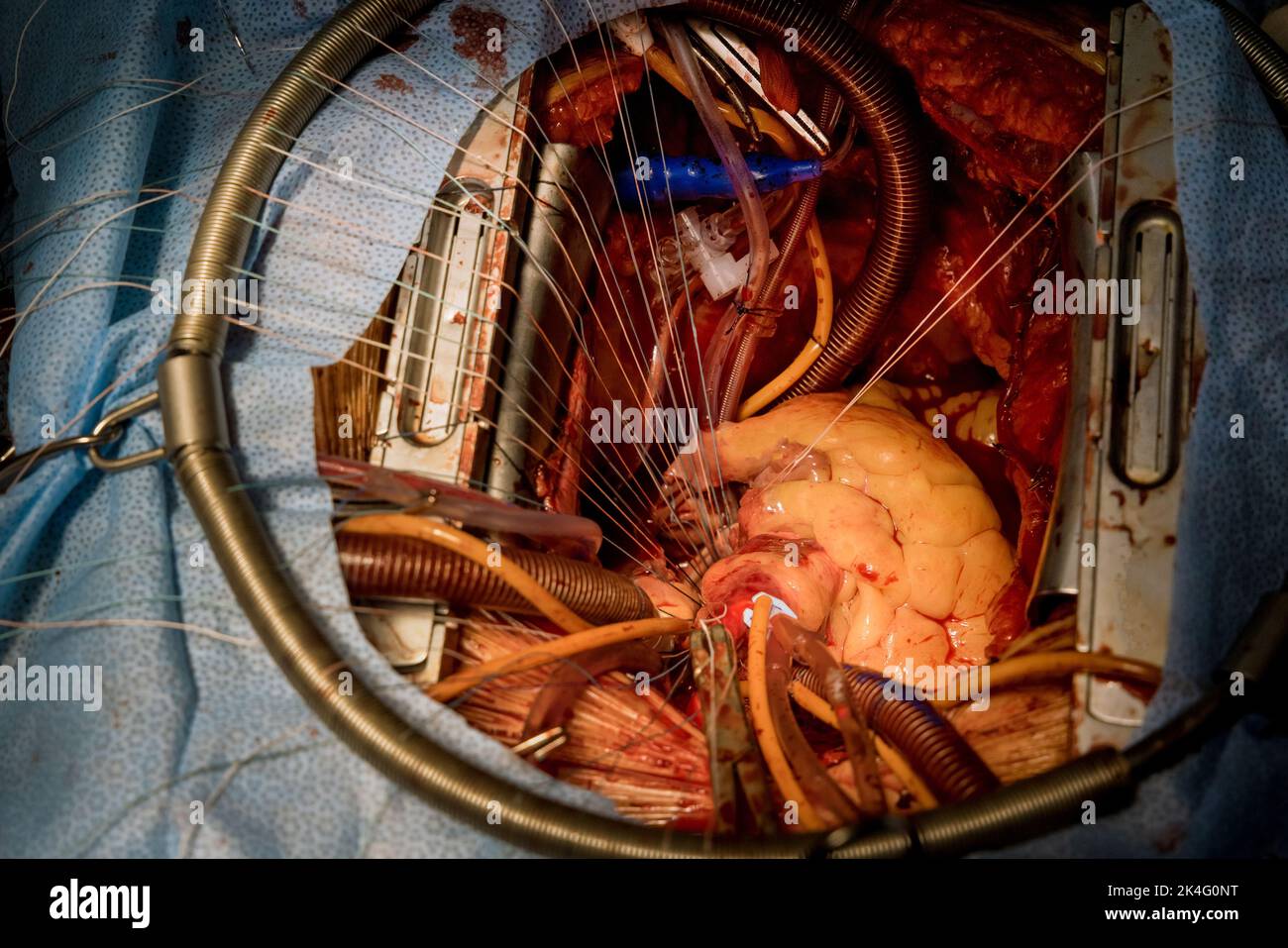 En raison d'un dysfonctionnement de la valve cardiaque, une chirurgie cardiaque ouverte est nécessaire pour le remplacement de la valve dans la salle d'opération et pendant la procédure Banque D'Images