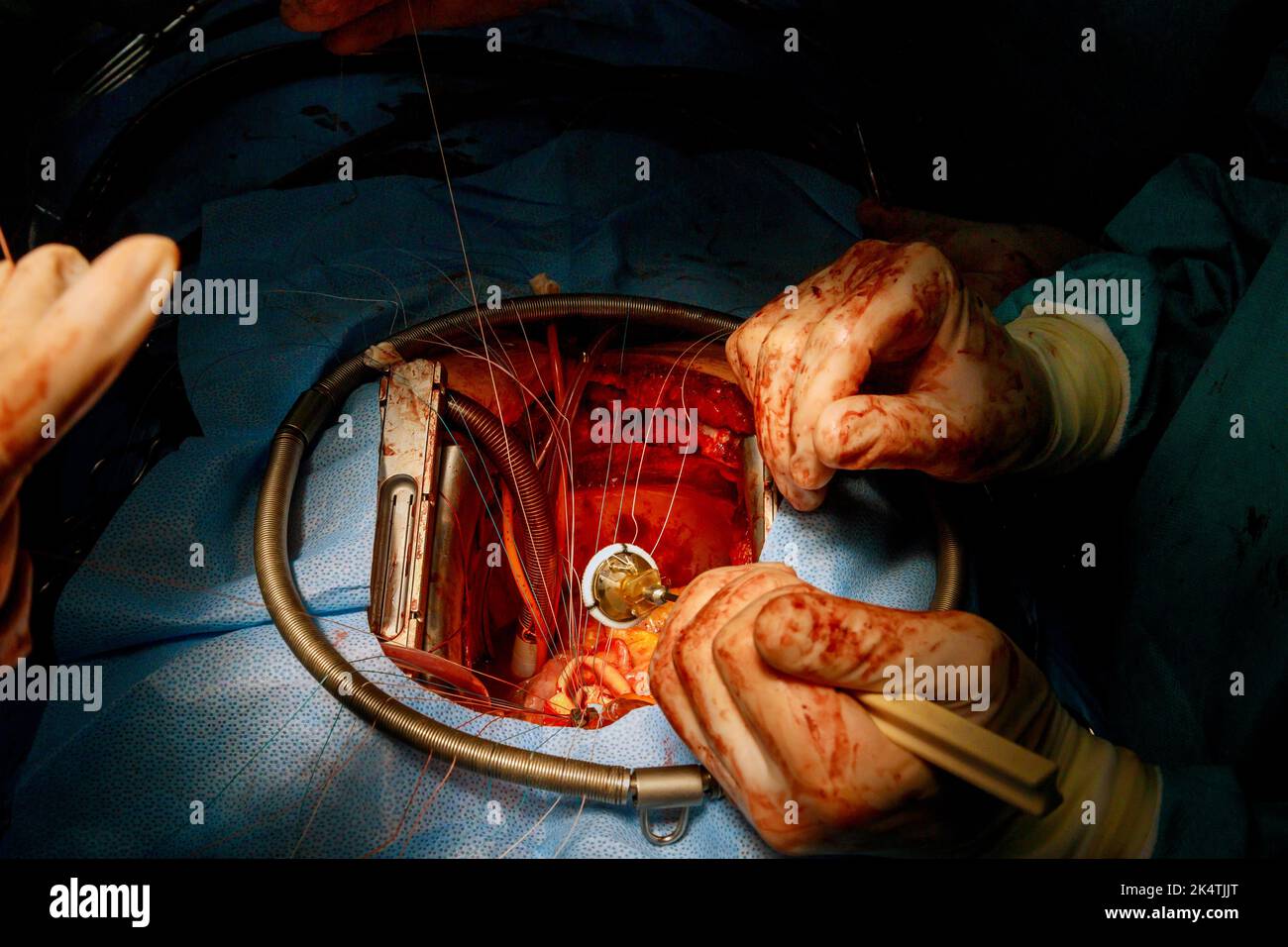 En raison d'un dysfonctionnement de la valve cardiaque, le médecin effectue une opération cardiaque ouverte pour remplacer la valve cardiaque dans la salle d'opération Banque D'Images