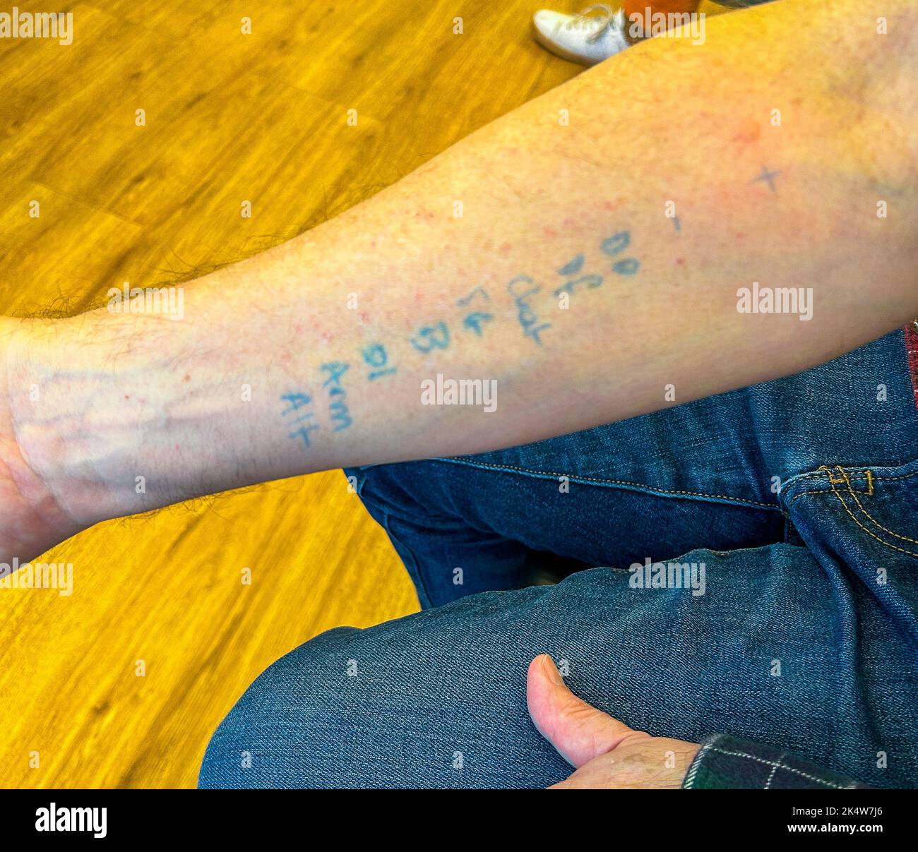 Paris, France, Man's Arm, Detail, avec des marques de tests cutanés d'allergie Banque D'Images