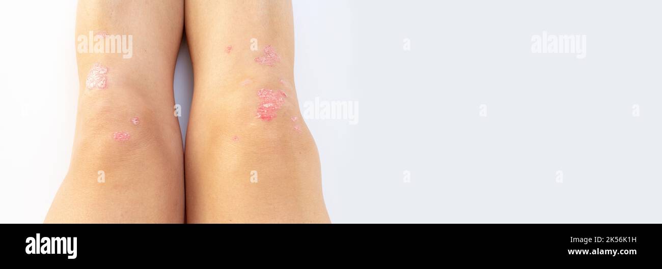Arthrite psoriasique avec psoriasis cutané sur les genoux d'une femme. Liquide synovial chez un patient atteint de psoriasis de l'articulation gauche du genou. Arthrite inflammatoire Banque D'Images
