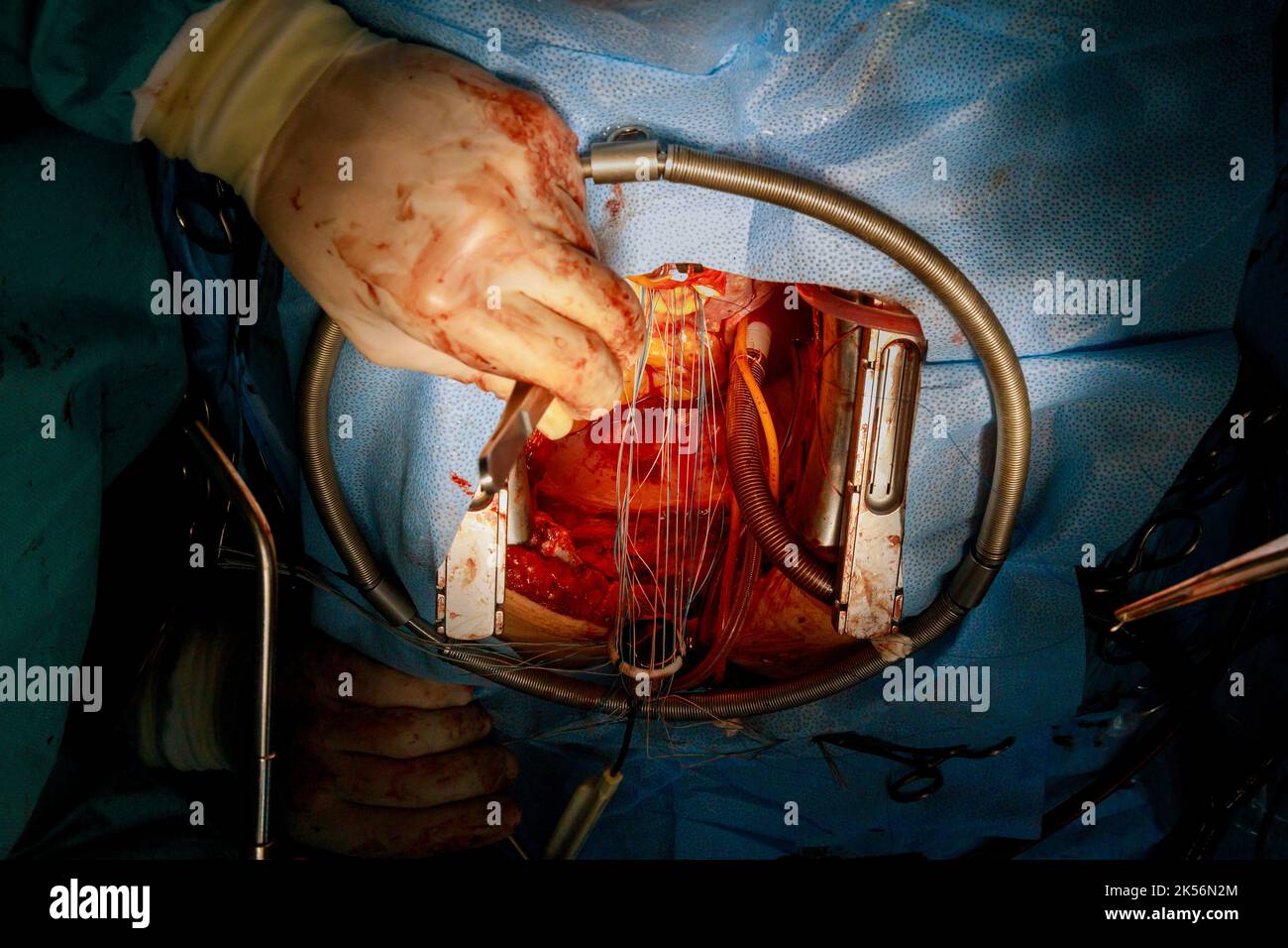 En raison d'un dysfonctionnement de la valve cardiaque, une opération cardiaque ouverte du coeur est nécessaire, où la valve est remplacée dans la salle d'opération Banque D'Images