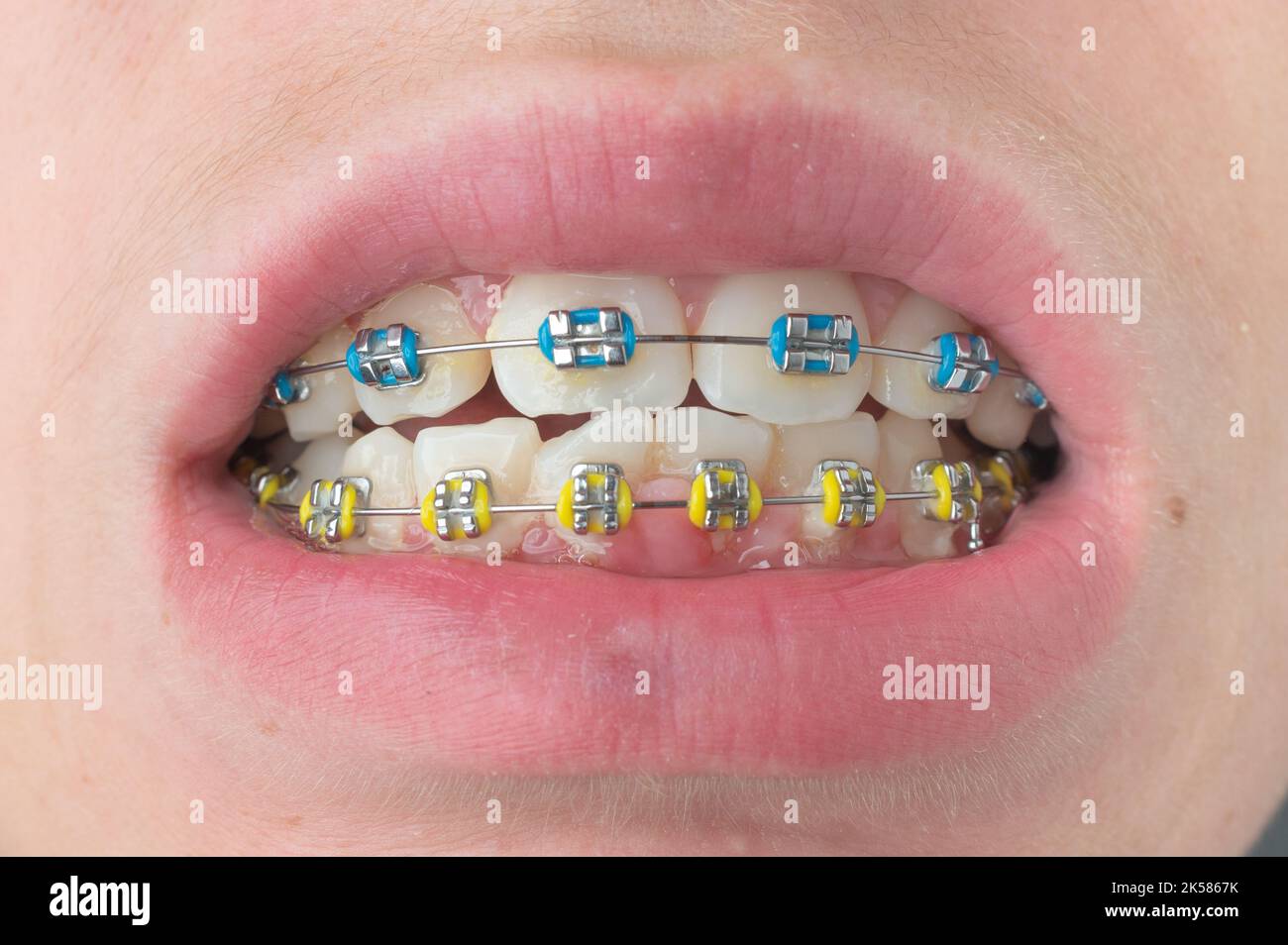 Renfort métal bandes bleu dents lèvres peau réparation dentaire  orthodontique ortho Photo Stock - Alamy