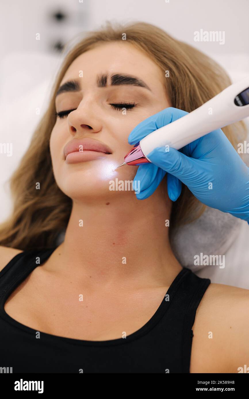 Gros plan macro du stylo laser plasma éliminant la verrue faciale chez la jeune femme. Traitement cosmétique non invasif Banque D'Images