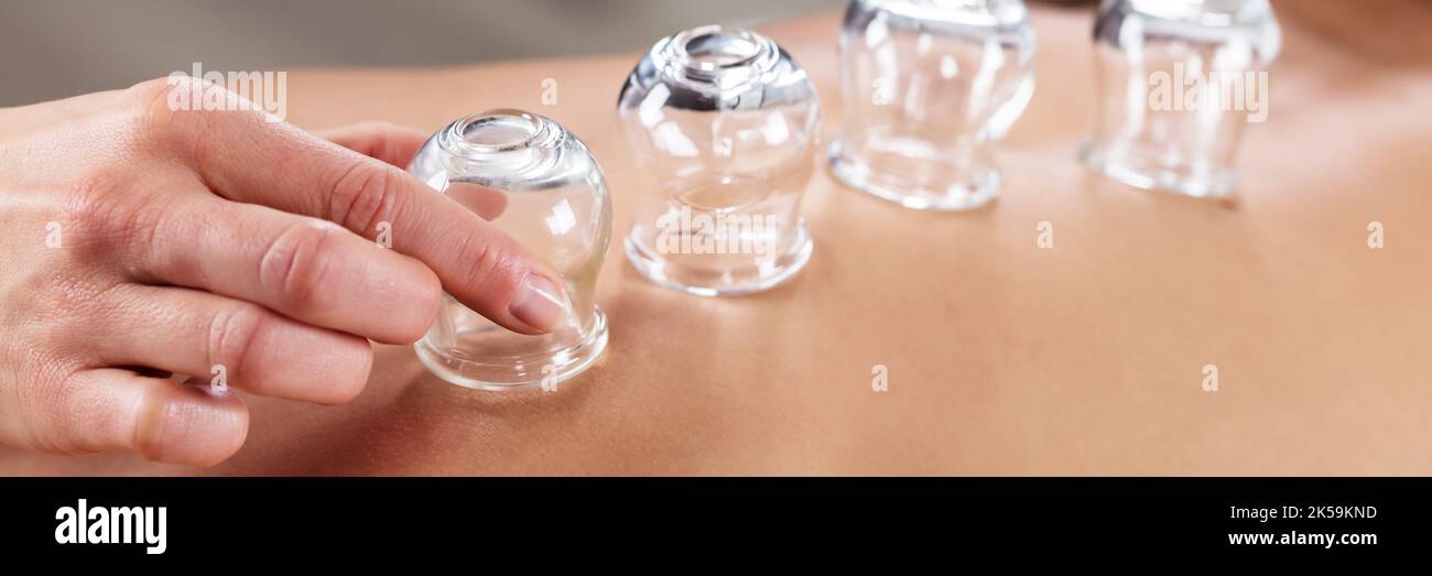 Cupping Therapy à l'aide de verre chinois sous vide. Massage de la tasse Banque D'Images